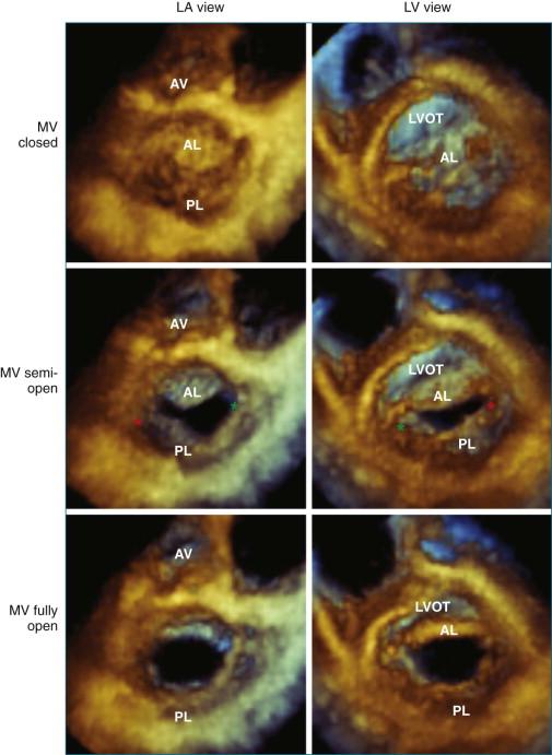 Figure 5-8, The mitral valve ( MV ) leaflets displayed from a cropped three-dimensional full-volume dataset obtained during a transthoracic exam. The leaflets are viewed from the left atrium ( LA ) on the left and from the left ventricle ( LV ) on the right . Red asterisk , anterolateral commissure; green asterisk , posteromedial commissure; AL , anterior leaflet; AV , aortic valve; LVOT , left ventricular outflow tract; PL , posterior leaflet.