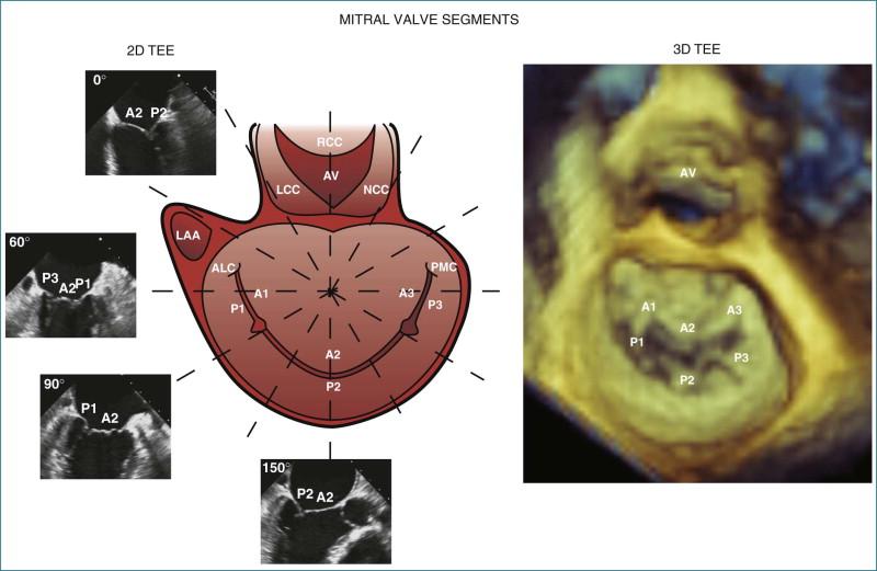 Figure 5-9, Two-dimensional (2D) imaging ( left ) shows only parts of the mitral valve leaflets in any given view. To mentally reconstruct the exact location of leaflet pathology during a 2D exam, one must have an excellent working knowledge of mitral valve anatomy. With three-dimensional imaging ( right ), the entirety of both leaflets can be seen in one view. ALC, anterolateral commissure; AV, aortic valve; LAA, left atrial appendage; LCC, left coronary cusp; NCC, noncoronary cusp; PMC, posteromedial commissure; TEE, transesophageal echocardiography; A1, A2, A3, P1, P2, and P3, scallops of the mitral valve leaflets.