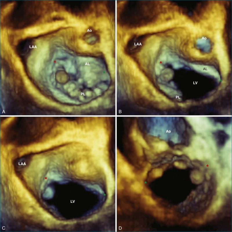 Figure 5-10, A mitral valve fibroelastoma clearly seen on P1 close to the anterolateral commissure ( red asterisk ) in this three-dimensional wide-sector view. A and B show the tumor from the surgeon's view in systole and diastole. It is also seen prolapsing into the ventricle from the left atrial view in C. In D, the tumor is seen in diastole as viewed from the apex. Green asterisk , posteromedial commissure. Ao, aortic valve; AL, anterior leaflet; LAA, left atrial appendage; LV, left ventricle; PL, posterior leaflet.