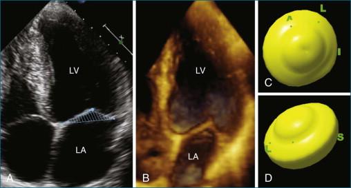 Figure 5-11, Mitral valve tenting. The tenting volume is shown in two-dimensions in A and is highlighted by the corresponding three-dimensional view ( B ). The tenting volume is calculated and shown in relation to the annulus in C and D. L, lateral; LA, left atrium; LV, left ventricle; S, septal.