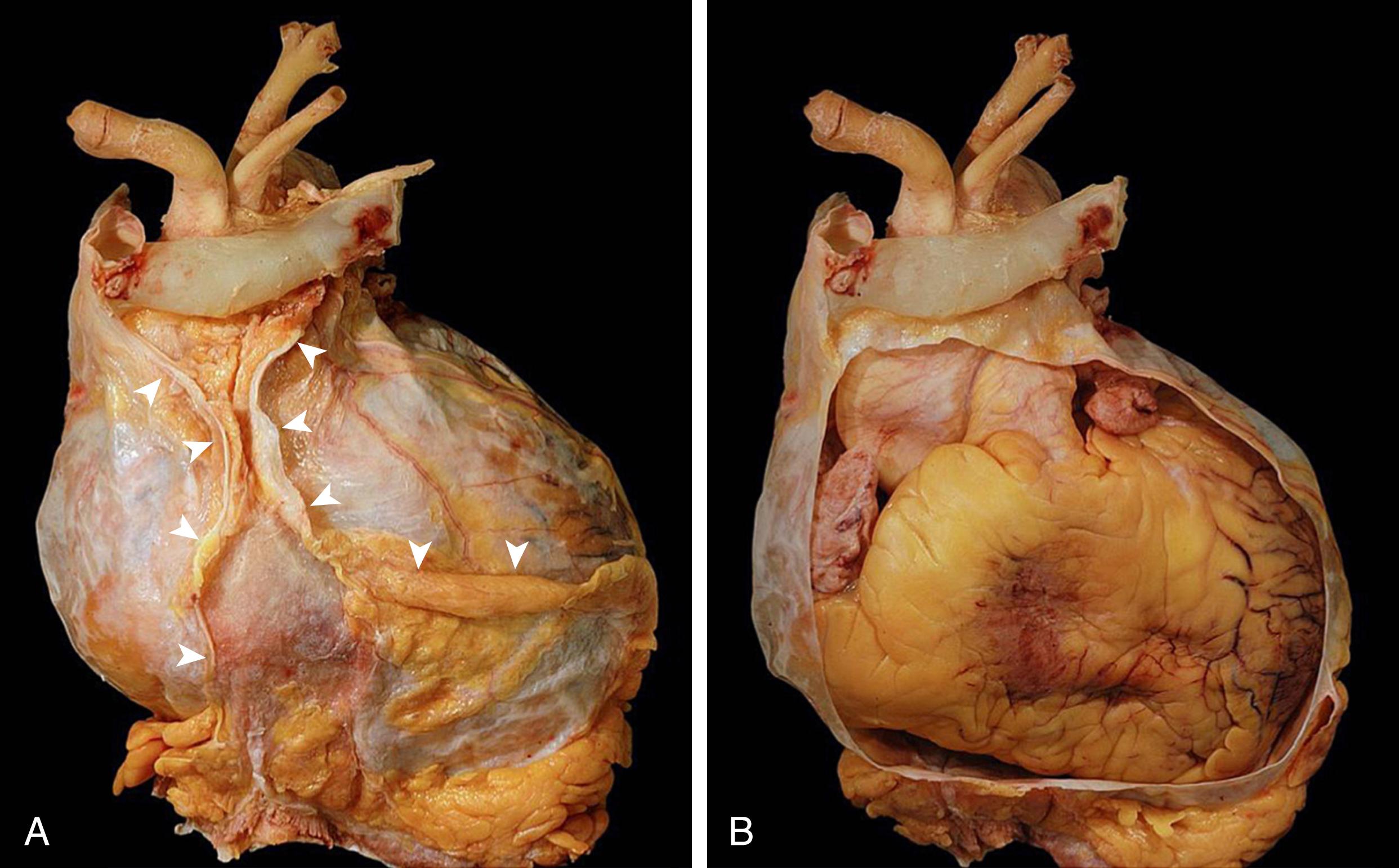 Figure 119.1, Gross anatomy of normal human pericardium. A, Anterior view of the intact parietal pericardial sac. The attachment of the fibrous sac to the diaphragm is seen at the base. Abundant epipericardial fat is conspicuously present at the pericardium–diaphragm junction. The mediastinal pleura invests the lateral portion of fibrous pericardium. The anterior reflections of the mediastinal pleura are indicated by the white arrowheads . The space between the arrowheads corresponds to the attachment of the pericardium to the posterior surface of the sternum. Superiorly, the left innominate vein is seen merging with the superior vena cava. The arterial branches of the aortic arch are just dorsal to the innominate vein. B, The anterior portion of the pericardial sac has been removed to show the heart and great vessels in anatomic position. It distinctly shows how the proximal segments of the great arteries are intrapericardial. At that point, there is fusion of the adventitia of the great vessels with the fibrous pericardium.