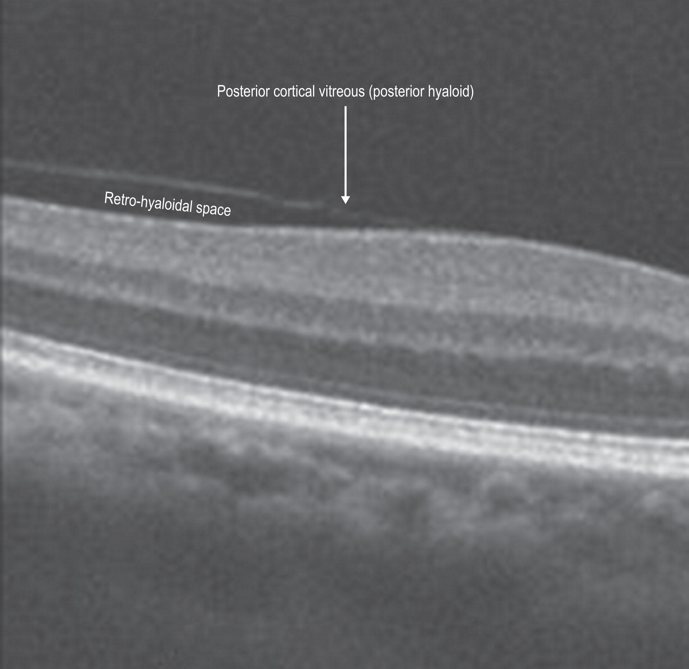 Figure 4.1.2, Vitreous features in a normal eye with partial, shallow vitreous separation.
