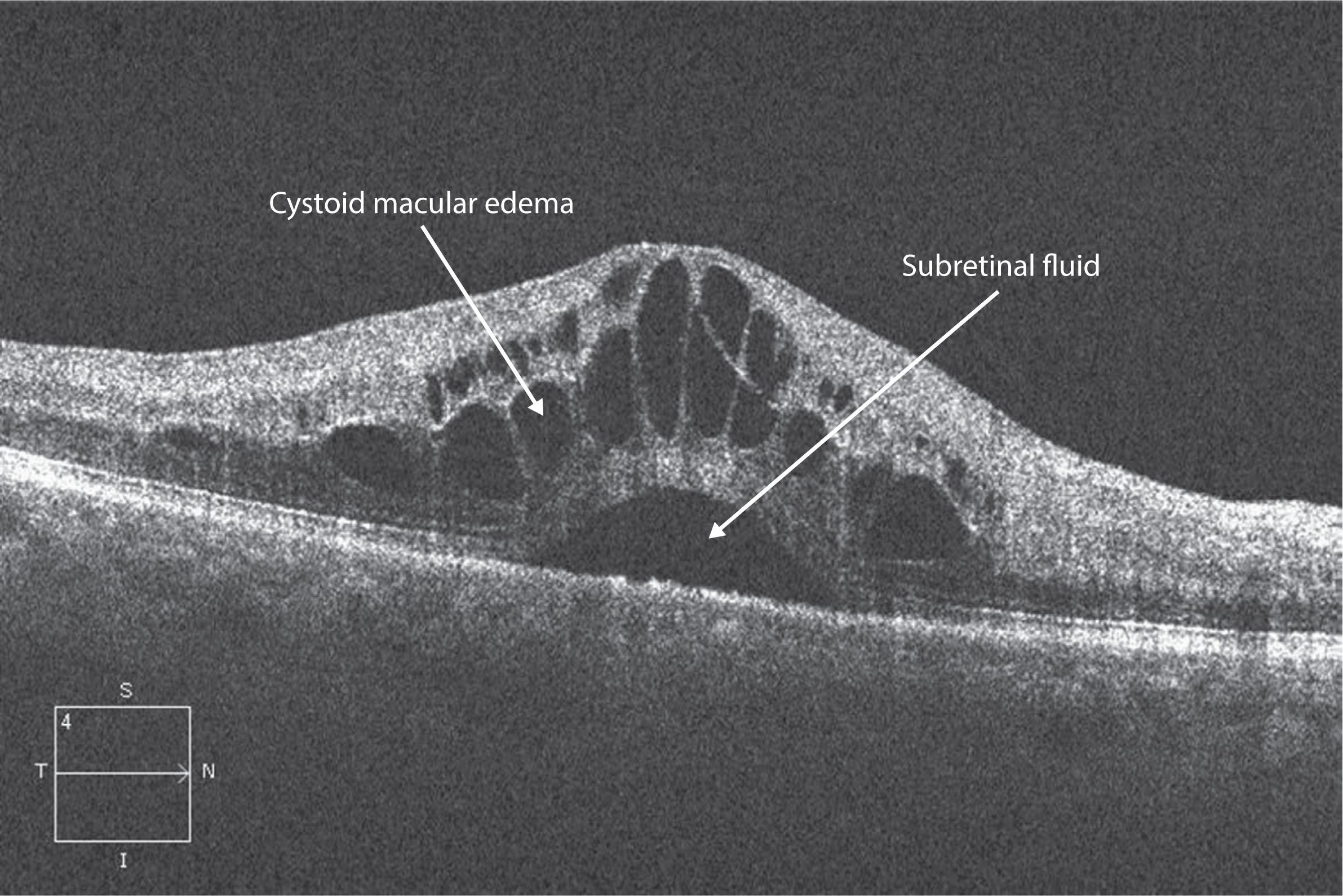 Figure 4.1.4, Cystoid changes in retina.