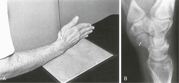 eFIGURE 13–4, A , Standard lateral view is obtained with the hand 90 degrees to the cassette and the elbow flexed 90 degrees and adducted to the person's side. B , Standard lateral view radiograph. The palmar margin of the pisiform (arrow) should lie between the volar surface of the distal tuberosity of the scaphoid and the volar surface of the proximal curvature of the capitate. This is the “SPC” relationship.