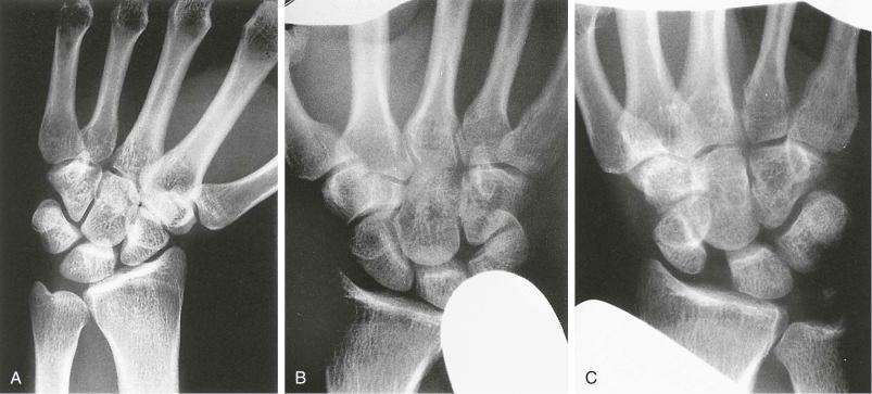 eFIGURE 13–5, A , Posteroanterior view with radial deviation. B , Posteroanterior view with passive ulnar displacement stress. The wrist is forcibly displaced ulnarly with respect to the forearm by the examiner's lead-gloved hands. This shows radioscaphoid joint space widening with ulnar translation of the carpus. C , Posteroanterior view with passive radial displacement stress shows widening of the scapholunate space and narrowing of the radioscaphoid space with radial translation of the carpus. The wrist is forcibly displaced radially with respect to the forearm by the examiner's lead-gloved hands.