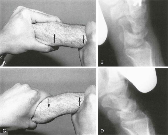 eFIGURE 13–6, A , Capitolunate instability pattern (CLIP) wrist maneuver with application of dorsally directed stress to the carpus (dorsally directed arrow) while the distal forearm is displaced volarly (volarly directed arrow) . The wrist may also be held in ulnar deviation during all of the CLIP wrist maneuver, which may allow more laxity at the midcarpal level. B , Lateral radiograph during application of CLIP maneuver with dorsally directed stress. The capitate may normally sublux on the lunate less than half the width of the capitate head. C , CLIP wrist maneuver with application of ventrally directed stress to the carpus (ventrally directed arrow) while the distal forearm is displaced dorsally (dorsally directed arrow) . D , Lateral radiograph during application of CLIP maneuver with ventrally directed stress. A transient volar-flexed intercalated segment instability configuration can commonly be produced as shown here.