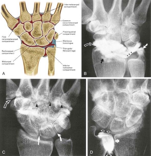 eFIGURE 13–7, A , Illustration of the major and minor compartments of the wrist. B , Normal arthrogram after injection into the radiocarpal joint. Contrast agent flows into the prestyloid recess (white arrow) , the ventral radial recess (single black arrow) , and the dorsoscaphoid recess (curved arrow) and outlines the distal surface of the triangular fibrocartilage (arrowheads) . Density in the distal radioulnar joint (DRUJ) is residual from a prior DRUJ arthrogram. C , Normal arthrogram after injection into the midcarpal joint. Contrast agent flows into the scapholunate (straight white arrow) and lunotriquetral (curved white arrow) joints, outlining the ligaments along their distal surfaces, between the carpal bones, and into the carpometacarpal joints II to V (arrowheads) . No contrast agent passes into the first carpometacarpal joint (open arrow) . D , Normal DRUJ arthrogram. There is no connection between the DRUJ and the radiocarpal joint. Open arrows outline the proximal surface of the triangular fibrocartilage, the white arrow identifies the ulnar notch of the distal radius, and arrowheads indicate minimal leakage out the proximal DRUJ capsule. The contrast agent in the radiocarpal and midcarpal joints is from a prior injection.