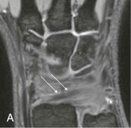 eFIGURE 13–9, A , Coronal 3D gradient-recalled-echo 3.0-tesla MR image shows the volar short radiolunate/radiolunotriquetral ligament (arrows) . B , Coronal 3D gradient-recalled-echo 3.0-tesla MR image shows volar radioscaphocapitate (arrows) and radiolunotriquetral (dashed arrows) ligaments. C , Coronal 3D gradient-recalled-echo 3.0-tesla MR image shows dorsal capitotriquetral (arrows) and lunotriquetral ligaments (dashed arrows) . D , Sagittal 3D gradient-recalled-echo 3.0-tesla MR image shows dorsal ulnotriquetral (arrow) , palmar ulnotriquetral (diamond arrowhead) , dorsal radioulnar (dashed arrow) , and palmar radioulnar ligaments (circle arrowhead) . E , Coronal 3D gradient-recalled-echo 3.0-tesla MR image shows lunotriquetral ligament (arrow) . F , Coronal 3D gradient-recalled-echo 3.0-tesla MR image shows palmar segment of the radioscapholunate ligament (arrow) . G , Coronal 3D gradient-recalled-echo 3.0-tesla MR image shows dorsal capitotriquetral (arrows) and lunotriquetral ligaments (dashed arrows) . H through L , Hand, axial T1 MR images. 1, Abductor digiti minimi muscle. 2, Abductor pollicis brevis muscle. 3, Abductor pollicis muscle. 4, Base of first metacarpal. 5, Base of fourth metacarpal. 6, Base of second metacarpal. 7, Base of third metacarpal. 8, Distal phalanx of thumb. 9, Dorsal interossei muscles. 10, Flexor digiti minimi muscle. 11, Flexor pollicis brevis muscle. 12, Head of fifth metacarpal. 13, Head of first metacarpal. 14, Lumbrical muscle. 15, Metacarpal shaft. 16, Opponens digiti minimi muscle. 17, Opponens pollicis muscle. 18, Palmar interossei muscles. 19, Proximal phalanx of index finger. 20, Superficial palmar arch. 21, Tendon of extensor digiti minimi muscle. 22, Tendon of extensor digitorum muscle. 23, Tendon of flexor pollicis longus muscle. 24, Tendon of extensor pollicis longus muscle. 25, Tendon of flexor digitorum profundus muscle. 26, Tendon of flexor digitorum superficialis muscle. M through Q , Hand, coronal T1 MR images. 1, Abductor digiti minimi muscle. 2, Abductor pollicis brevis muscle. 3, Abductor pollicis muscle. 4, Base of proximal phalanx. 5, Capitate. 6, Common palmar digital artery. 7, Deep palmar arch. 8, Distal phalanx of thumb. 9, Dorsal interossei muscles. 10, Flexor digiti minimi muscle. 11, Flexor pollicis brevis muscle. 12, Hamate. 13, Head of fifth metacarpal. 14, Head of first metacarpal. 15, Lumbrical muscle. 16, Middle phalanx. 17, Opponens digiti minimi muscle. 18, Opponens pollicis muscle. 19, Palmar interossei muscles. 20, Proper palmar digital artery. 21, Proximal phalanx of thumb. 22, Shaft of proximal phalanx. 23, Tendon of extensor pollicis longus muscle. 24, Tendon of flexor digitorum profundus muscle. 25, Tendon of flexor digitorum superficialis muscle. 26, Tendon of flexor pollicis longus muscle. 27, Trapezium. 28, Trapezoid. 29, Proper collateral ligament (PCL). R through T , Finger, axial T1 MR images. 1, Extensor digitorum communis. 2, Extensor indicis tendon. 3, Flexor digitorum profundus. 4, Flexor digitorum superficialis. 5, Extensor digiti quinti minimi. 6, Proper collateral ligament. 7, Ulnar collateral ligament. 8, Volar plate. U and V , At the level of the proximal interphalangeal joint. 1, Central slip of the extensor tendon. 2, Lateral bands of the extensor tendon. 3, Landsmeer's transverse ligament (LTL). 4, Cleland's ligaments. 5, Grayson's ligaments. 6, Laterovolar compartments with proper digital neurovascular bundles (dashed regions) . 7, Flexor tendons. 8, Volar plate. 9, Accessory collateral ligament (ACL). W , At the level of the distal interphalangeal joint. 1, Distal extensor tendon. 2, Flexor digitorum profundus tendon. 3, Proper collateral ligament. X through Z , Hand, sagittal T1 MR images. 1, Scaphoid. 2, Lunate. 3, Capitate. 4, Second metacarpal. 5, Third metacarpal. 6, Proximal phalanx. 7, Flexor digitorum superficialis tendon. 8, Flexor digitorum profundus tendon. 9, Extensor digitorum tendon. 10, Thenar muscles. 11, Volar plate.