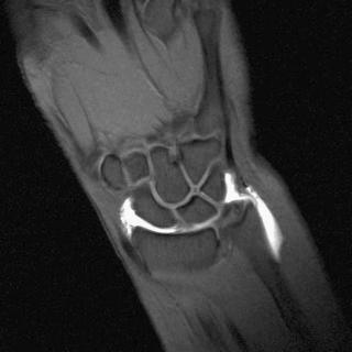 eFIGURE 13–10, Coronal T1-weighted fat-saturated MR arthrogram after injection into the radiocarpal joint. Contrast agent flows into the ulnar and radial recesses of the radiocarpal joint. There is also a small amount of contrast agent extravasated along the tendon sheath of the extensor carpi ulnaris.