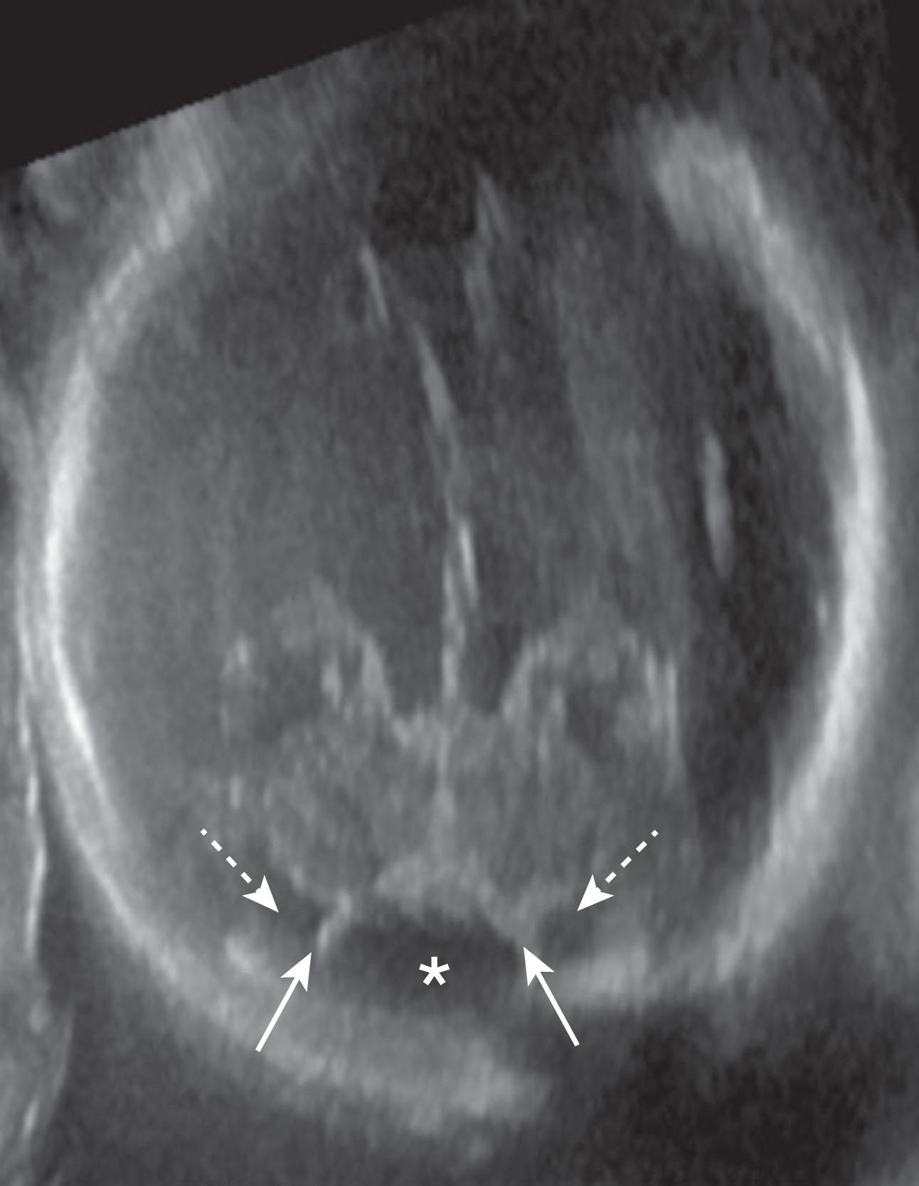 Fig. 4.18, Blake pouch cyst. Fetal ultrasound axial view in a 23-week-old fetus showing the septa (solid arrows) of the Blake pouch (asterisk) with the subarachnoid space on both sides (dashed lines) . The Blake pouch cerebrospinal fluid space is usually more echolucent than the adjacent subarachnoid space, which is bridged by pial-arachnoid septations.