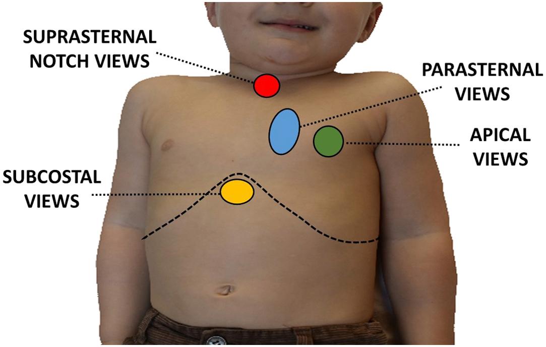 Figure 1, Location of different echocardiographic windows. Subcostal window (yellow), apical window (green), parasternal window (blue), suprasternal window (red).