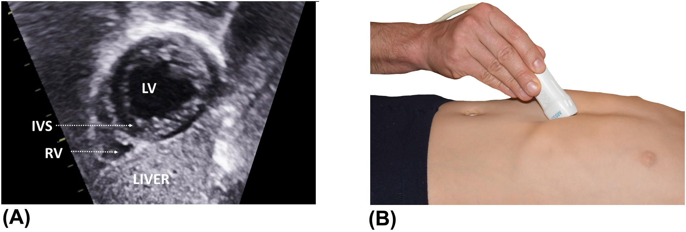 Figure 11, (A) Subcostal short-axis view with cross-sectional view of both ventricles. (B) The probe is further tilted to the patient's right as compared to the previous figure. IVS , interventricular septum; LV , left ventricle; RV , right ventricle.