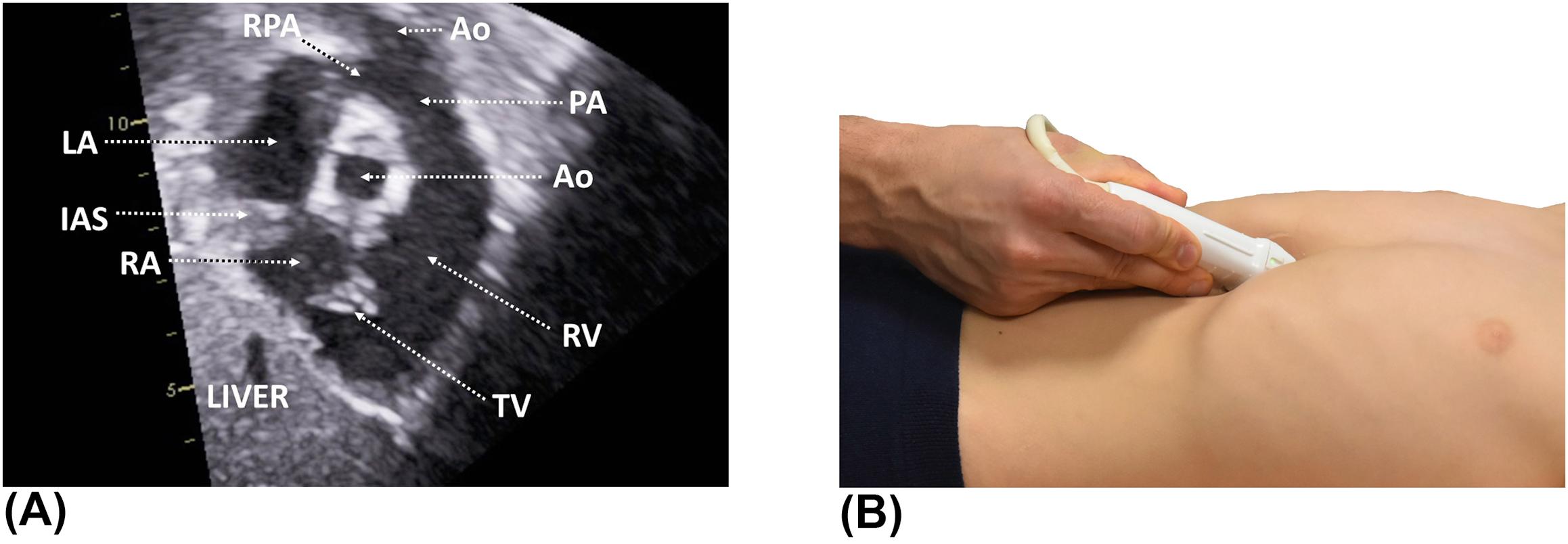 Figure 12, (A) Subcostal short-axis view demonstrating both atria, the tricuspid valve, and the entire right ventricular outflow tract. (B) This view is obtained by rotating the probe marker to the 1 o'clock position. The probe is slightly tilted to the patient's left. Ao , aorta; IAS , interatrial septum; LA , left atrium; LPA , left pulmonary artery; PA , pulmonary artery; RA , right atrium; RPA , right pulmonary artery; RV , right ventricle; TV , tricuspid valve.
