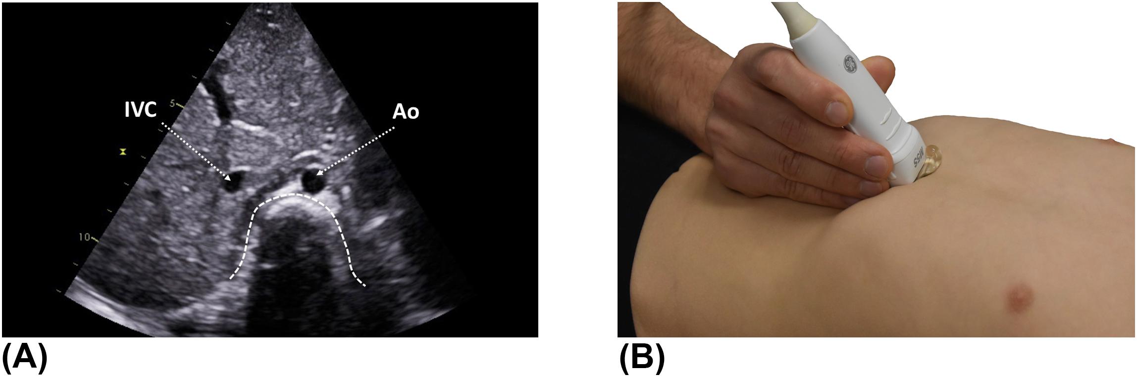 Figure 2, (A) Subcostal “situs” view (transverse plane). In normal abdominal situs, the abdominal aorta is to the left and the inferior vena cava to the right of the spine. (B) The probe marker is at the 3 o'clock position. Ao , aorta; IVC , inferior vena cava.