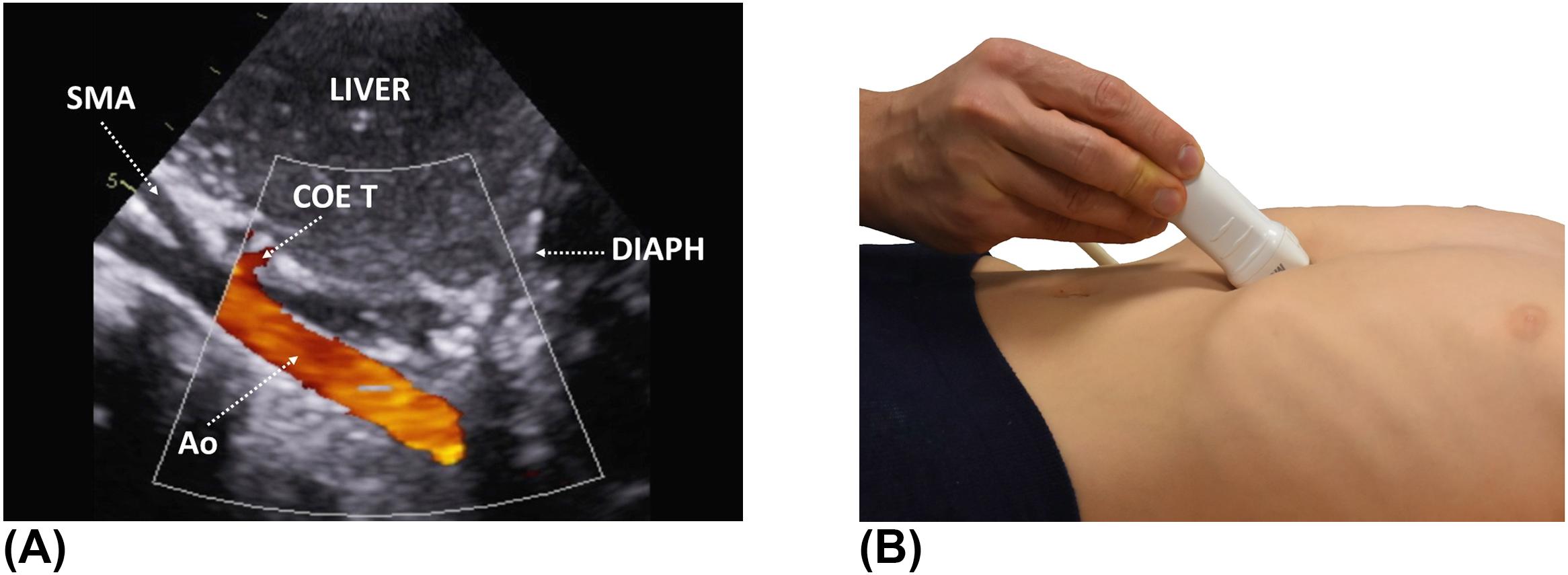 Figure 3, (A) Color flow Doppler of the abdominal aorta from the subcostal view. Pulsed-wave Doppler interrogation of the abdominal aorta is performed from this view. (B) The probe is at the 6 o'clock position, angulated inferiorly. Ao , aorta; COE T , celiac trunk; DIAPH , diaphragm; SMA , superior mesenteric artery.