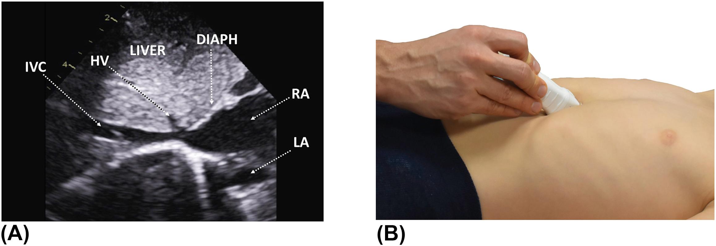 Figure 4, (A) Subcostal view showing the drainage of the inferior vena cava and the hepatic veins into the right atrium. (B) The probe at the 6 o'clock position, tilted inferiorly and slightly to the patient's left. DIAPH , diaphragm; HV , hepatic vein; IVC , inferior vena cava; LA , left atrium; RA , right atrium.