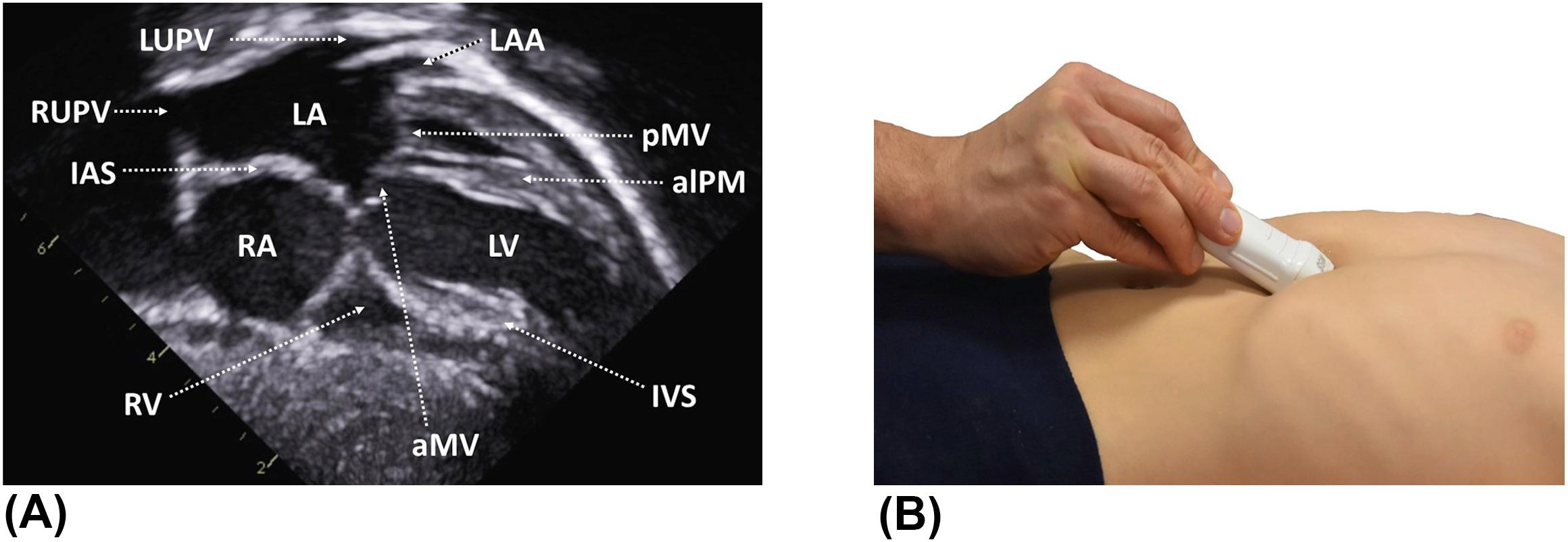 Figure 5, (A) Subcostal long-axis (four-chamber) view. The cardiac chambers, atrial and ventricular septae, and upper pulmonary veins are visualized. (B) The probe is at the 3 o'clock position, angulated inferiorly. alPM , anterolateral papillary muscle; aMV , anterior mitral valve leaflet; IAS , interatrial septum; IVS , interventricular septum; LA , left atrium; LAA , left atrial appendage; LUPV , left upper pulmonary vein; LV , left ventricle; pMV , posterior mitral valve leaflet; RA , right atrium; RUPV , right upper pulmonary vein; RV , right ventricle.