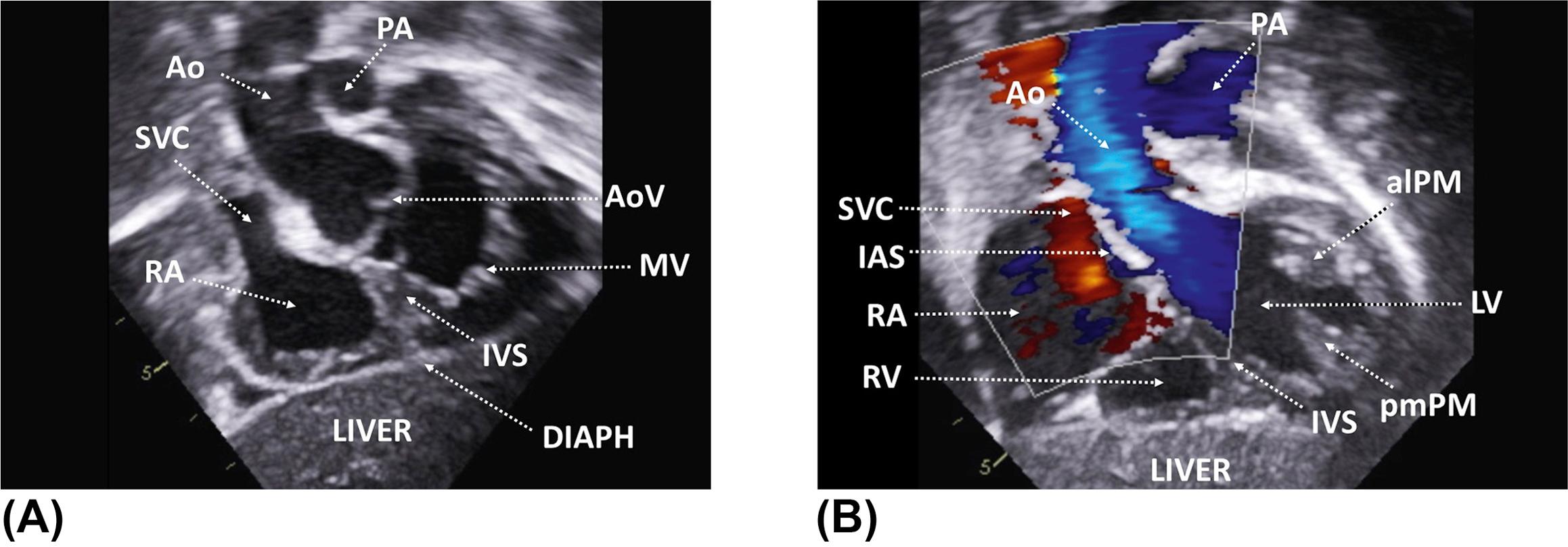 Figure 6, (A) Subcostal long-axis view showing the entire left ventricular outflow tract with the proximal ascending aorta. (B) Corresponding color flow Doppler. (C) The probe is further angulated inferiorly as compared to the previous figure. The marker remains at the 3 o'clock position. alPM , anterolateral papillary muscle; Ao , aorta; DIAPH , diaphragm; IAS , interatrial septum; IVS , interventricular septum; LV , left ventricle; MV , mitral valve; PA , pulmonary artery; pmPM , posteromedial papillary muscle; RA , right atrium; RV , right ventricle; SVC , superior vena cava.