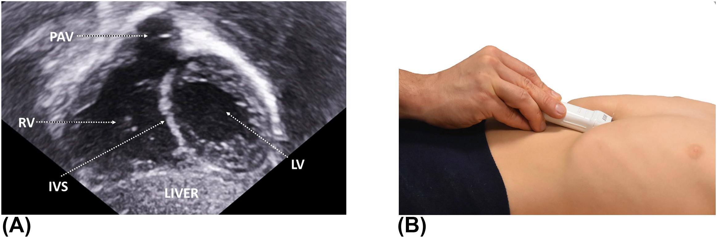 Figure 7, (A) Subcostal long-axis view showing both ventricles and the right ventricular outflow tract. (B) This view is obtained by a maximal inferior angulation of the probe. The marker is at the 3 o'clock position. alPM , anterolateral papillary muscle; IVS , interventricular septum; LV , left ventricle; PA , pulmonary artery; PAV , pulmonary valve; pmPM , posteromedial papillary muscle; RV , right ventricle.