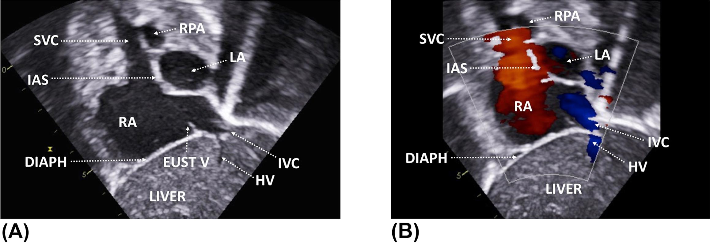 Figure 8, (A) Subcostal short-axis (bicaval) view showing both caval veins and atria. (B) Flow across the superior and inferior caval veins. (C) The probe is at the 5 o'clock position, tilted slightly to the patient's left. DIAPH , diaphragm; EUST V , Eustachian valve; HV , hepatic vein; IAS , interatrial septum; IVC , inferior vena cava; LA , left atrium; RA , right atrium; RPA , right pulmonary artery; SVC , superior vena cava.