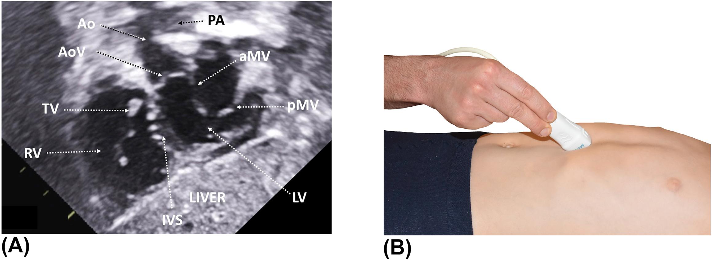 Figure 9, (A) Subcostal short-axis view showing the left ventricular outflow tract and the mitral valve. The interventricular septum is visualized en face. (B) The probe is slightly tilted to the patient's right as compared to the previous figure. aMV , anterior mitral valve leaflet; Ao , aorta; AoV , aortic valve; IVS , interventricular septum; LV , left ventricle; PA , pulmonary artery; pMV , posterior mitral valve leaflet; RV , right ventricle; TV , tricuspid valve.