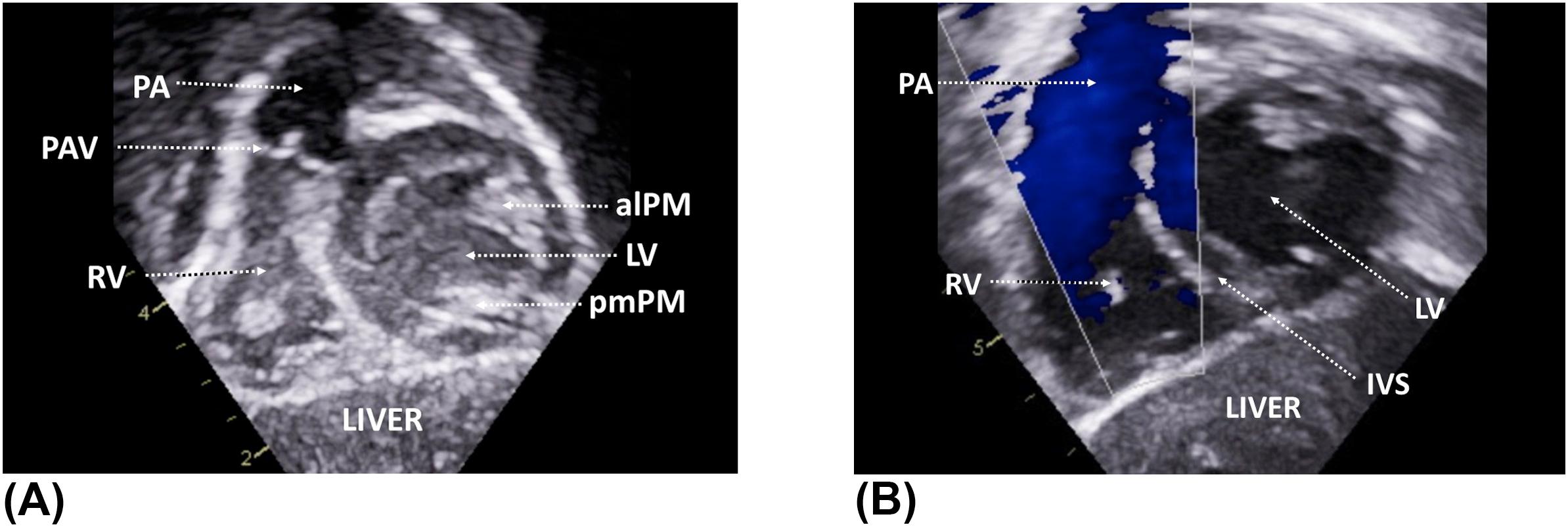Figure 10, (A) Subcostal short-axis view showing the entire right ventricular outflow tract. (B) Corresponding color flow Doppler. (C) The probe is further tilted to the patient's right as compared to the previous figure. alPM , anterolateral papillary muscle; IVS , interventricular septum; LV , left ventricle; PA , pulmonary artery; PAV , pulmonary valve; pmPM , posteromedial papillary muscle; RV , right ventricle.