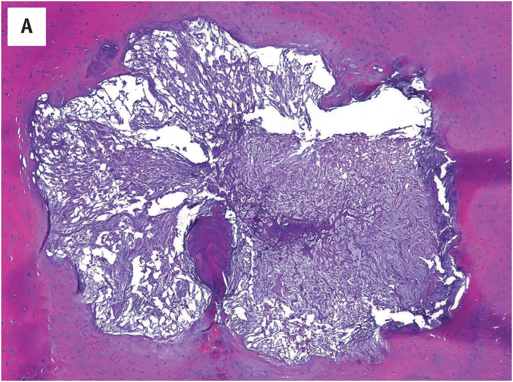 Fig. 21.1, Notochordal Remnants. (A) Notochordal remnant within intervertebral disc. (B) Gross photo of ecchordosis physaliphora, identified incidentally at autopsy. (C) Ecchordosis physaliphora composed of cohesive notochordal cells with some extracellular myxoid matrix, mimicking a conventional chordoma.