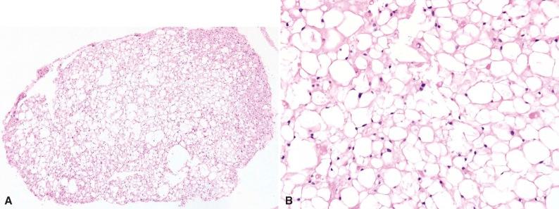 Figure 18-1, Ecchordosis. An incidental autopsy finding within the clivus, measuring 1.8 cm in greatest dimension. The mass is well circumscribed ( A ). Lesional cells show abundant eosinophilic to clear multivacuolated cytoplasm surrounding round to oval nuclei without atypia ( B ).