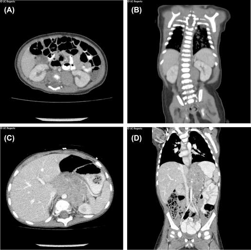 Figure 14.1, INRG staging, (A) CT axial image demonstrating L1 tumor (tumor involving one compartment with no IDRFs), (B) CT coronal image demonstrating L1 tumor (tumor involving one compartment with no IDRFs), (C) CT axial image demonstrating L2 tumor (loco-regional ipsilateral tumor with encasement of the major vessels which constitutes an IDRF), (D) CT coronal image demonstrating L2 tumor (loco-regional ipsilateral tumor with encasement of the major vessels which constitutes an IDRF).