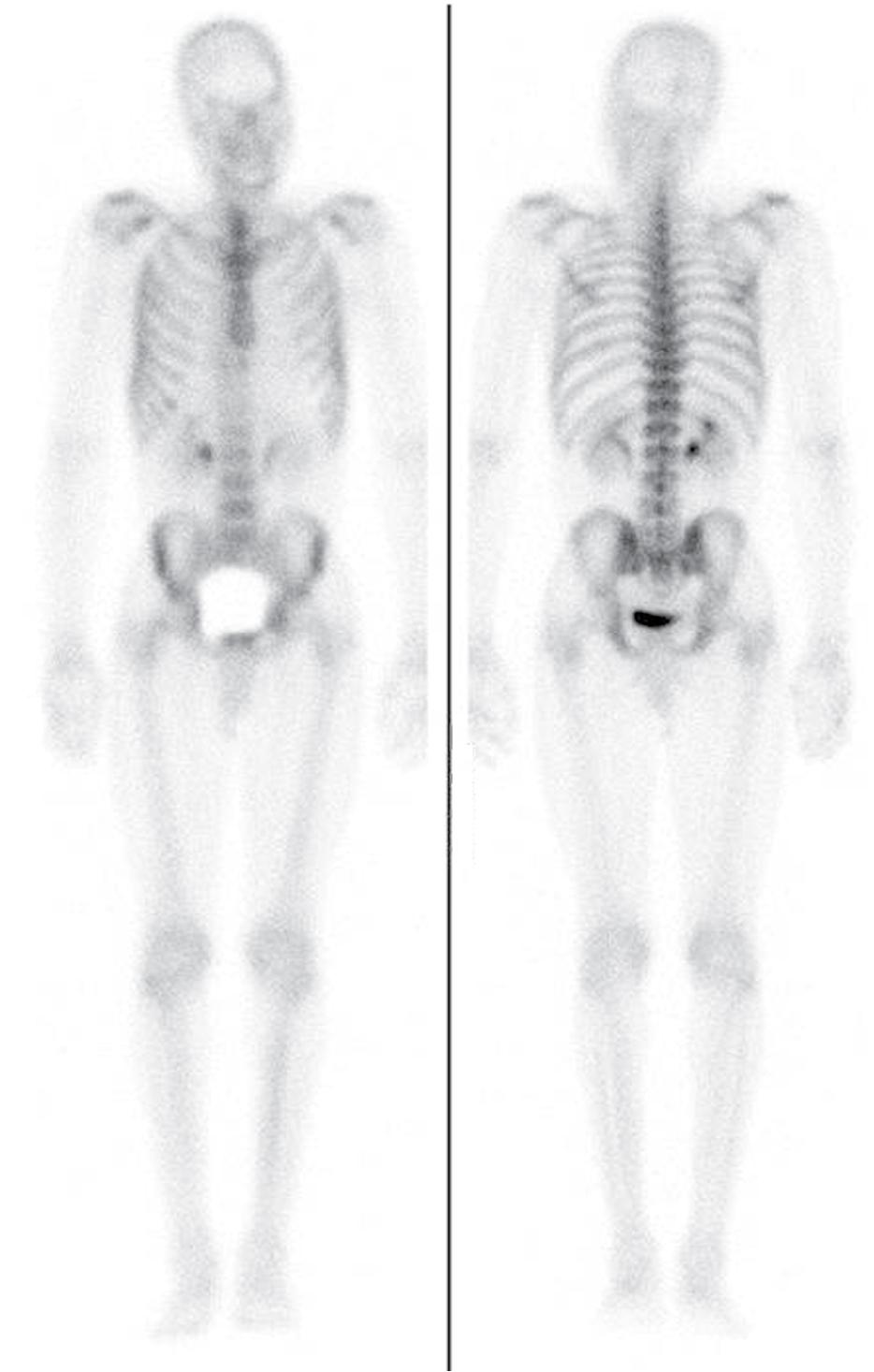 Fig. 12.1, Normal 99m Tc–MDP distribution on whole-body bone scan in anterior (left) and posterior (right) projections. Note uniform radiotracer uptake throughout bones with some uptake in kidneys and bladder.