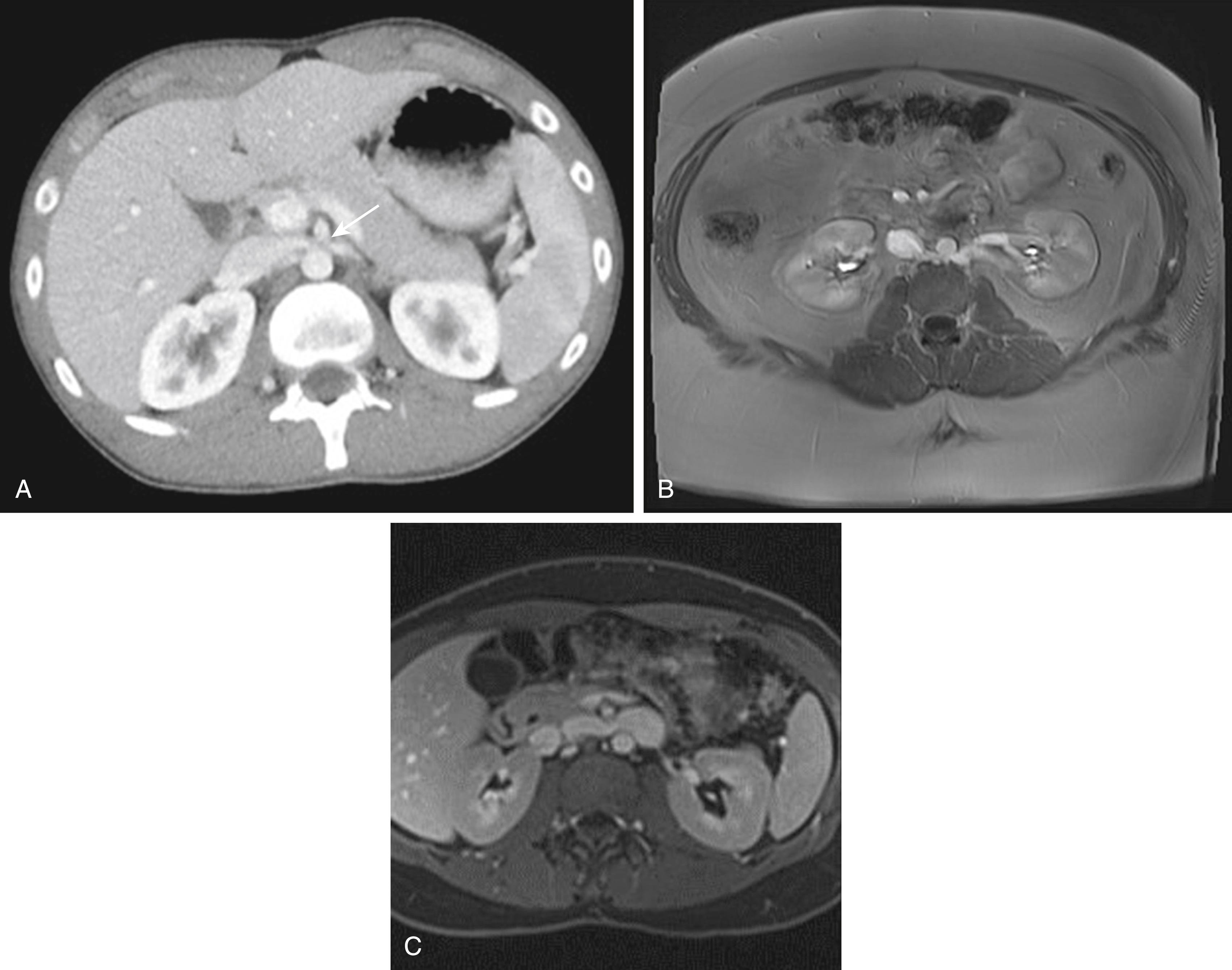 Figure 165.1, Cross-sectional imaging demonstrating ( A ) anterior nutcracker syndrome with compression of the left renal vein (arrow) between the aorta and superior mesenteric artery as observed by computed tomography; ( B ) posterior nutcracker syndrome with a retro-aortic renal vein as observed by magnetic resonance imaging; and ( C ) compression of the left-sided IVC by the SMA and the aorta.