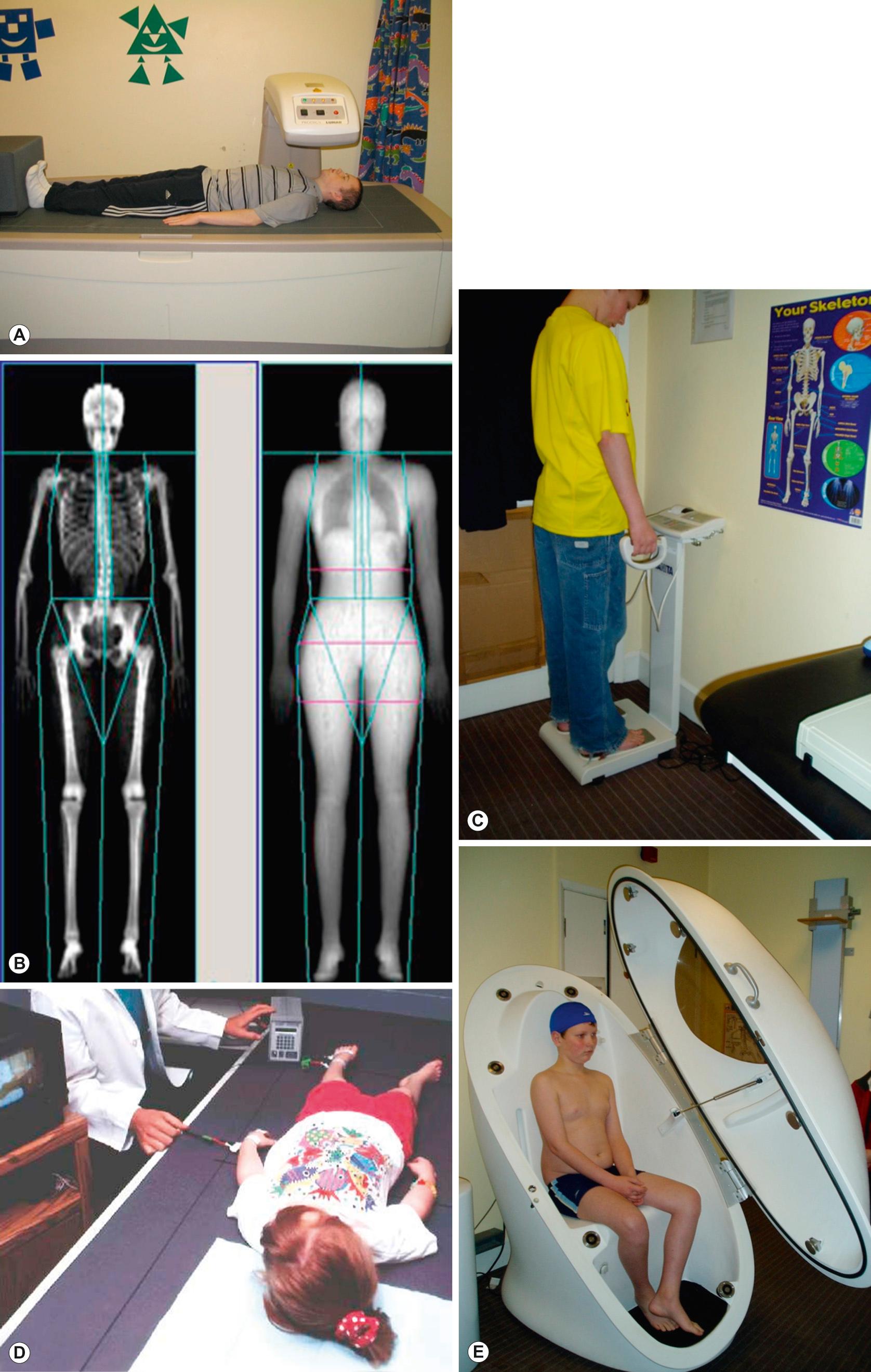 Fig. 13.1, Some techniques used to measure body composition in children. A,B. Child undergoing a dual energy X-ray absorptiometry (DXA) whole body scan and the image generated. C,D. Children undergoing bioelectric impedance analysis measurements with two types of machine (standing and supine). E. Air displacement plethysmography (BodPod), used to measure body volume by air displacement plethysmography.