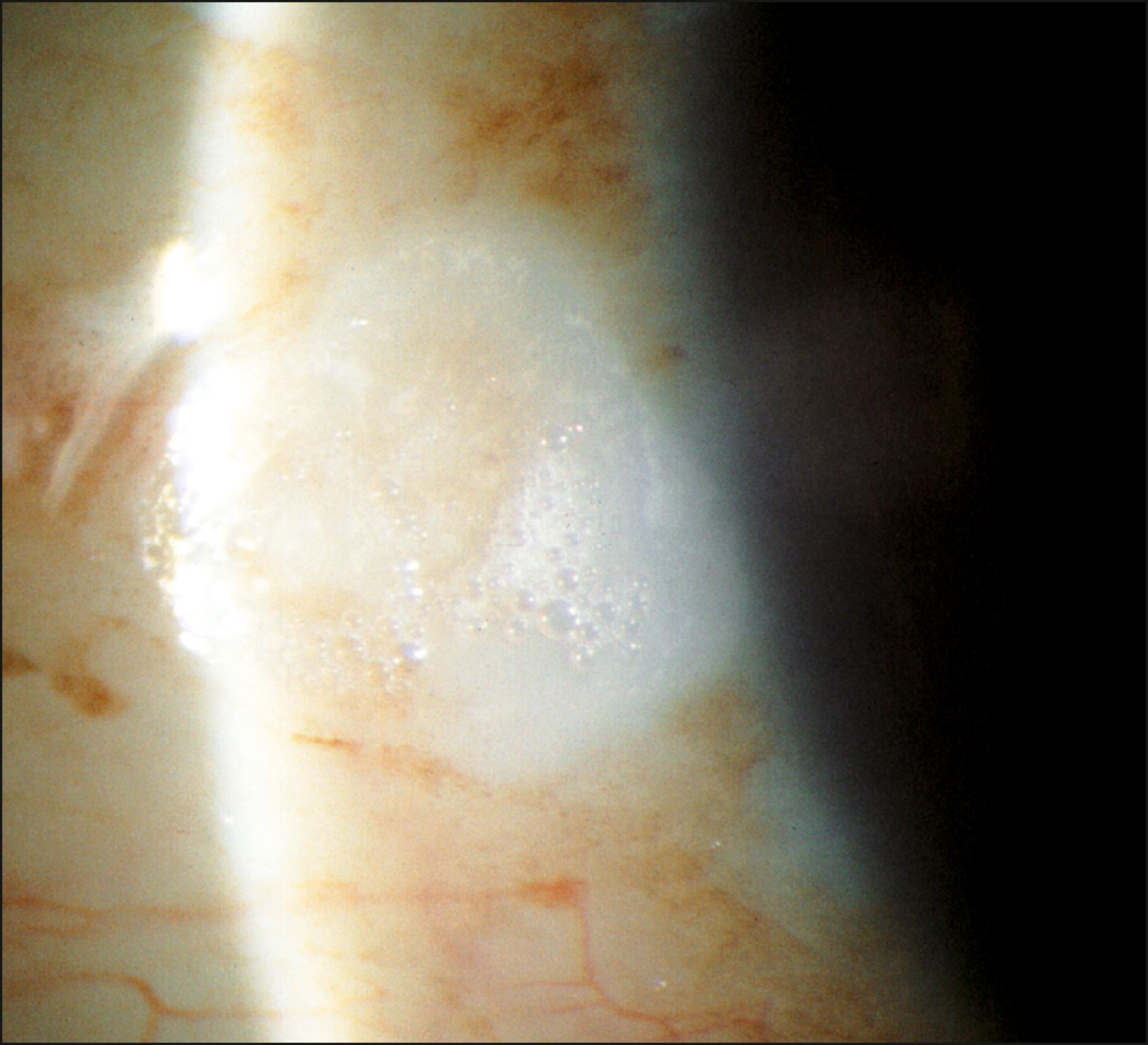 Fig. 61.2, Typical “foamy” Bitot spot.