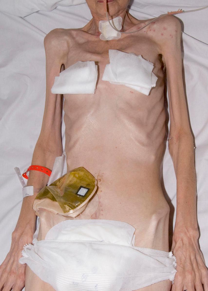 Fig. 5.3, Protein-energy malnutrition in a surgical patient illustrating markedly depleted muscle mass and loss of subcutaneous tissues.