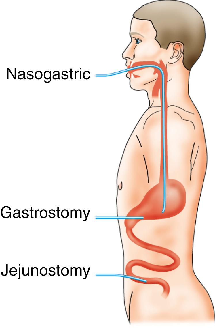 Fig. 5.5, Routes of enteral nutrition.