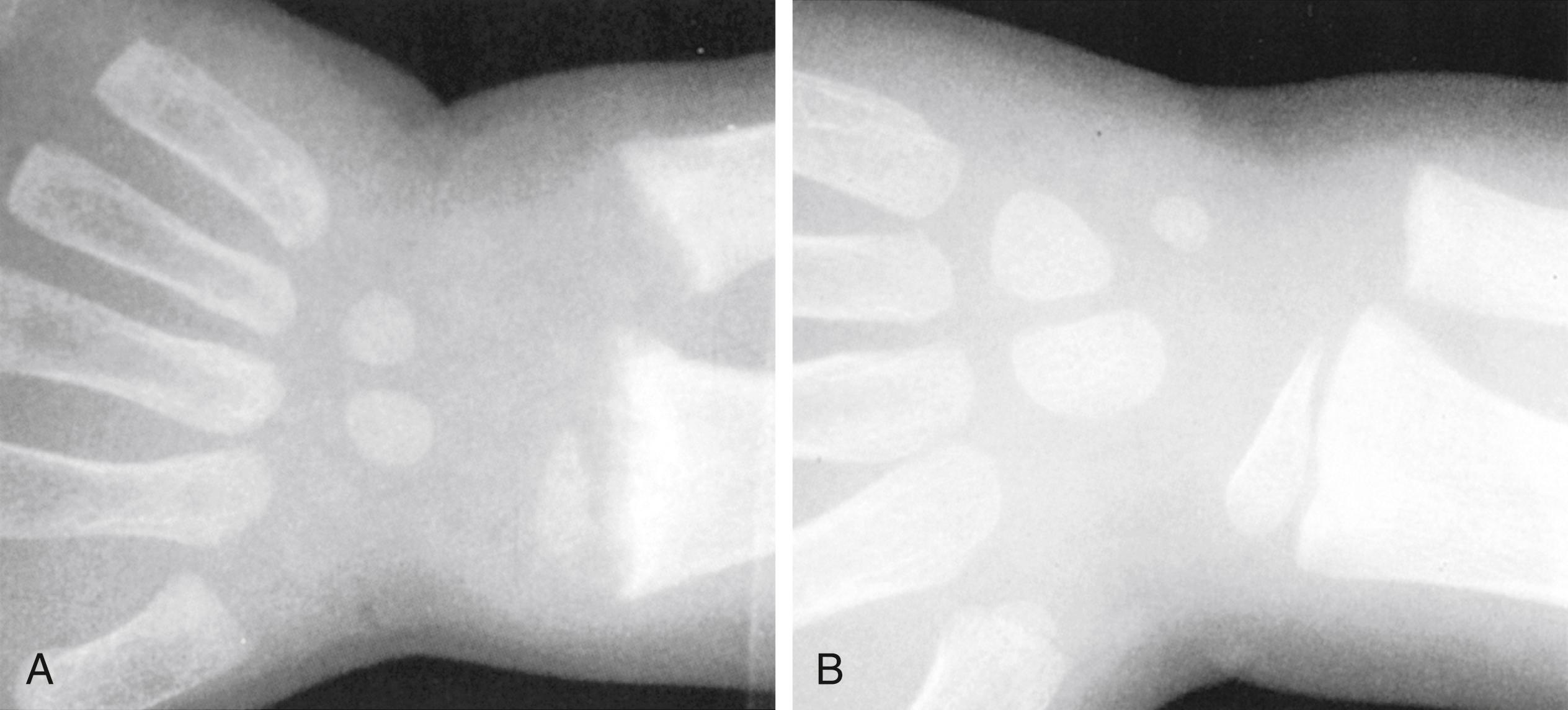 Fig. 11.11, Rickets. Radiograph of the wrist of a patient with rickets. (A) Irregularity and widening of the epiphyses in the distal radius and ulna. (B) With appropriate therapy, remineralization and healing occur.