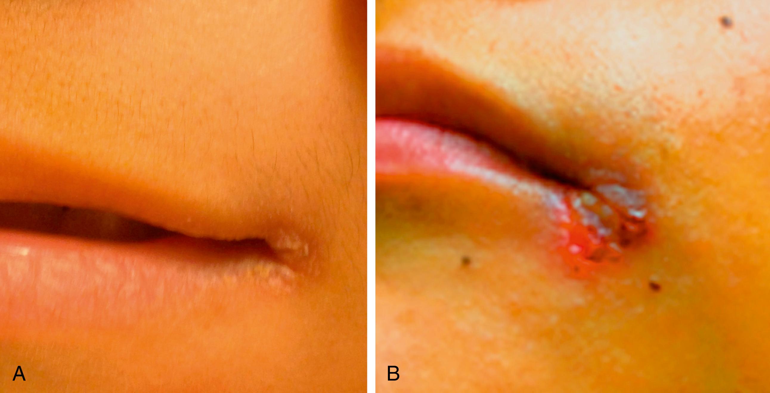 Fig. 11.12, Angular cheilitis. (A) Note the grayish white plaques at the corner of the mouth. This patient was diagnosed as having a vitamin B complex deficiency, likely the result of a chronic diarrheal state and inadequate dietary intake. (B) Prior to diagnosis and supplementation, the cheilitis advanced to an ulcerative lesion which could represent super-infection.