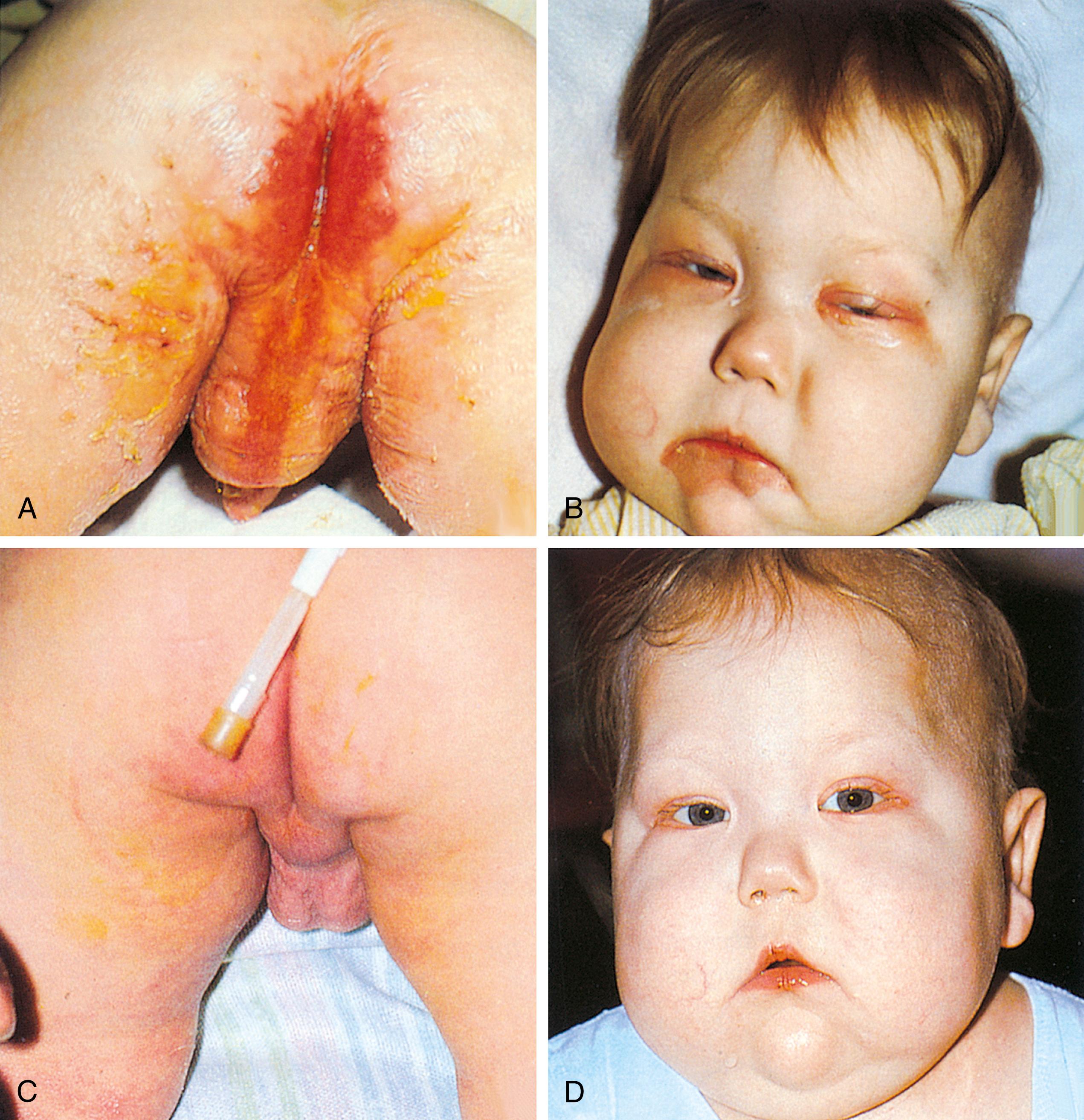 Fig. 11.13, Biotin deficiency. (A and B) This child on chronic hyperalimentation developed dermatitis in the perianal, perioral, and eyelid areas along with some thinning of hair. (C and D) The rash has cleared dramatically after 4 days of biotin.