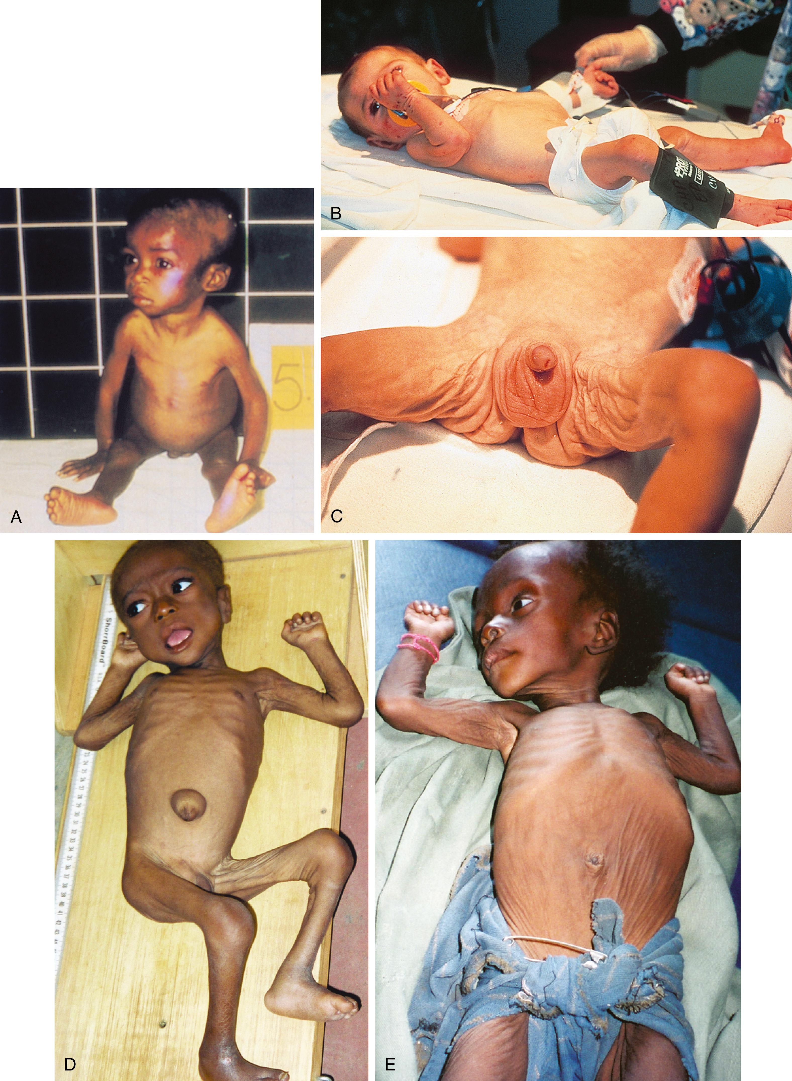 Fig. 11.3, Marasmus. (A) Note the profound wasting and sparse hair. (B and C) Note the wasting of subcutaneous tissue over the thorax with prominent ribs and loose skinfolds in the groin. (D and E) Note the loss of subcutaneous fat, profound wasting, loose skinfolds, and sparse hair.