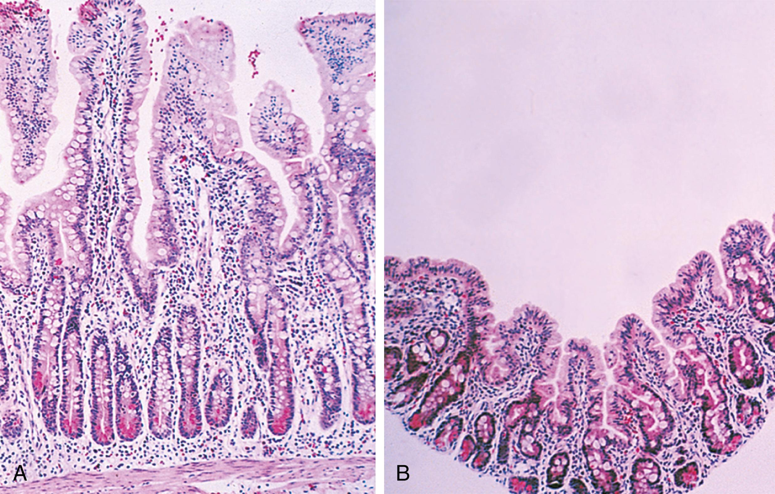 Fig. 11.4, Gastrointestinal tract injury associated with malnutrition. (A) Normal jejunal mucosa with tall villi and deep crypts. (B) Blunted villi lead to chronic diarrhea and malnutrition. Note the lack of increase in crypt depth and lymphocytic infiltrate seen in celiac disease (see Fig. 11.28 ) and other diseases with active cell turnover.