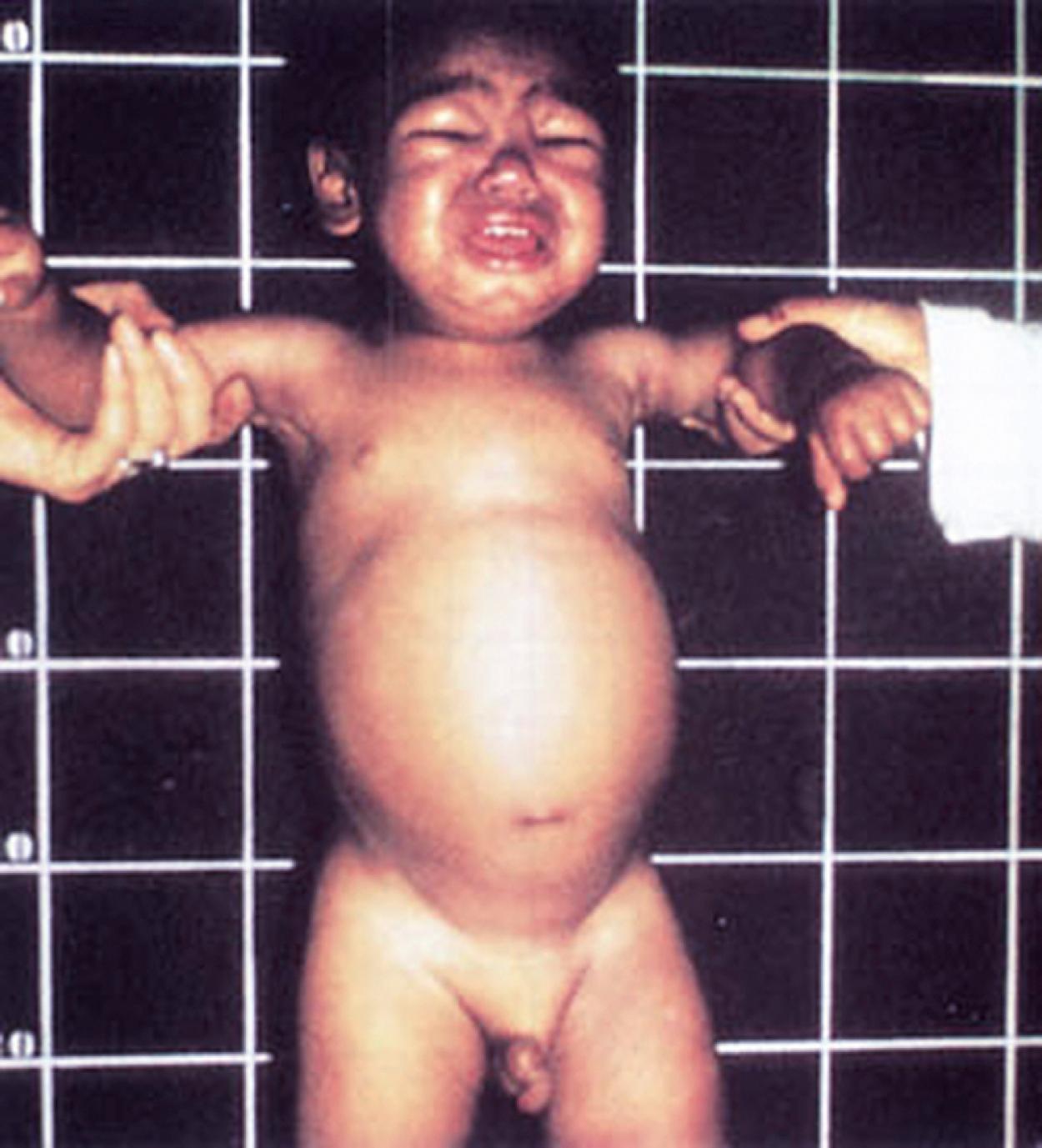 Fig. 11.5, Kwashiorkor. This patient has a typical edematous appearance in the periorbital area, extremities, and abdomen.