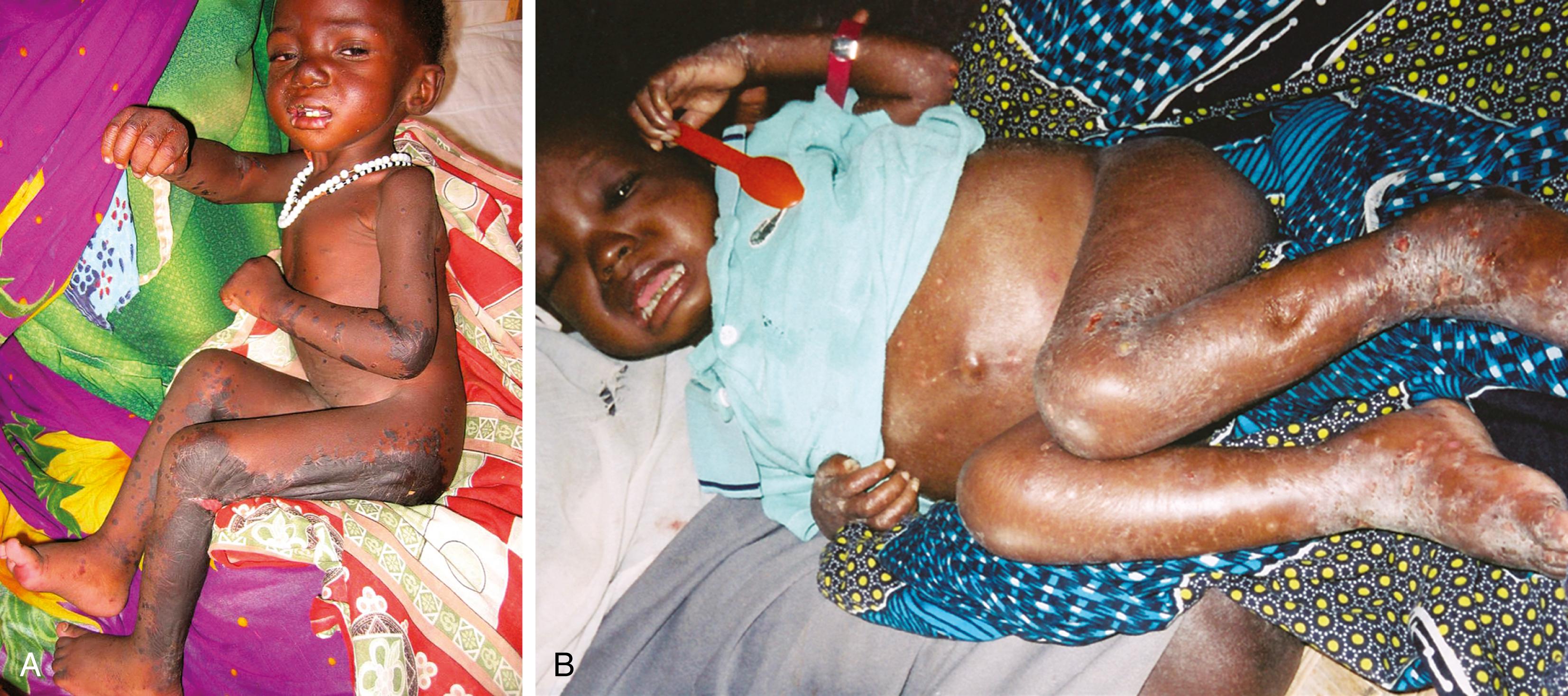 Fig. 11.6, Kwashiorkor. (A and B) These infants demonstrate kwashiorkor with “flaky paint” dermatosis, pigmentation changes, and pitting edema.