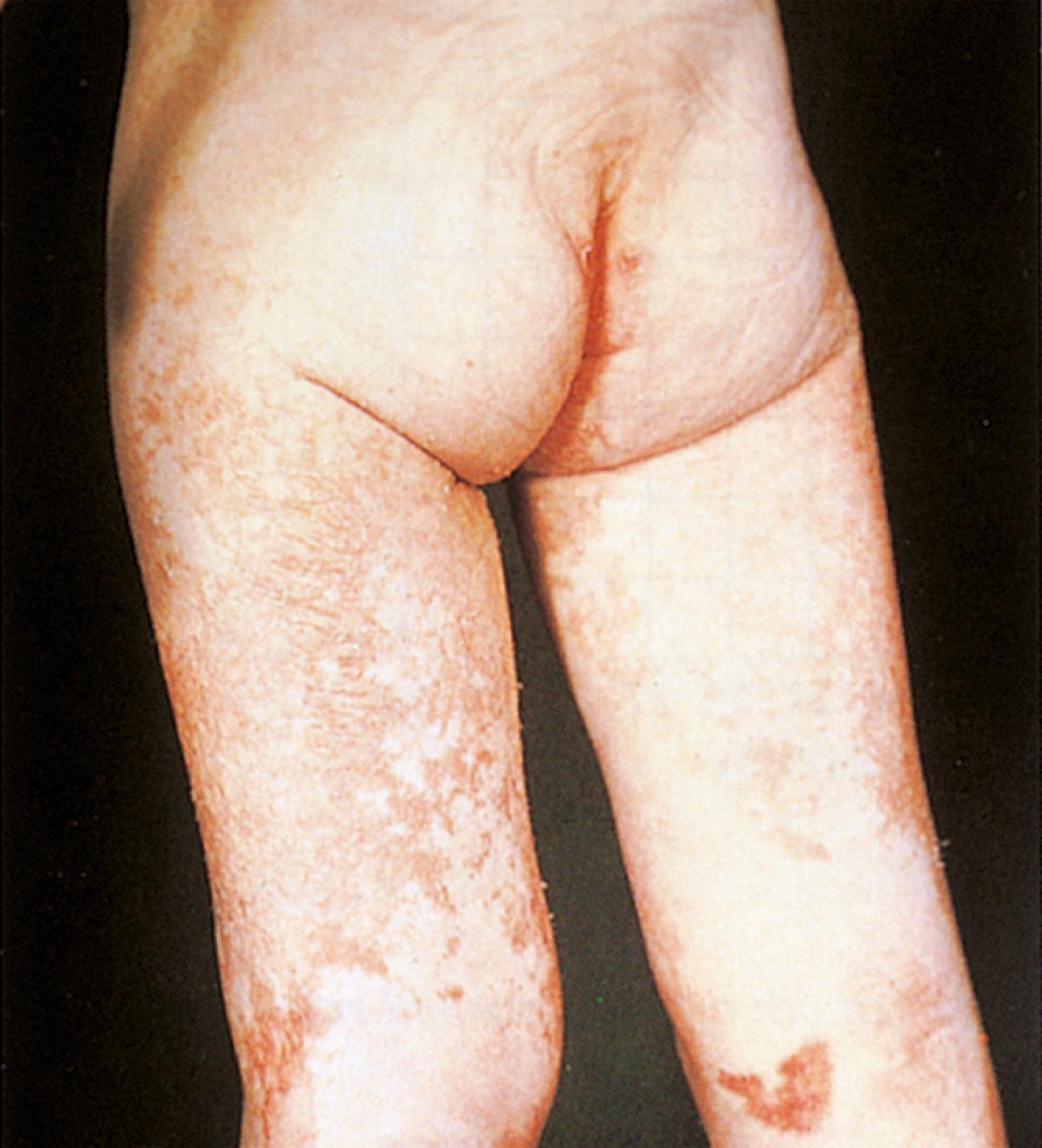 Fig. 11.7, Kwashiorkor. The rash of kwashiorkor is scaly and erythematous and may weep, especially in edematous areas.