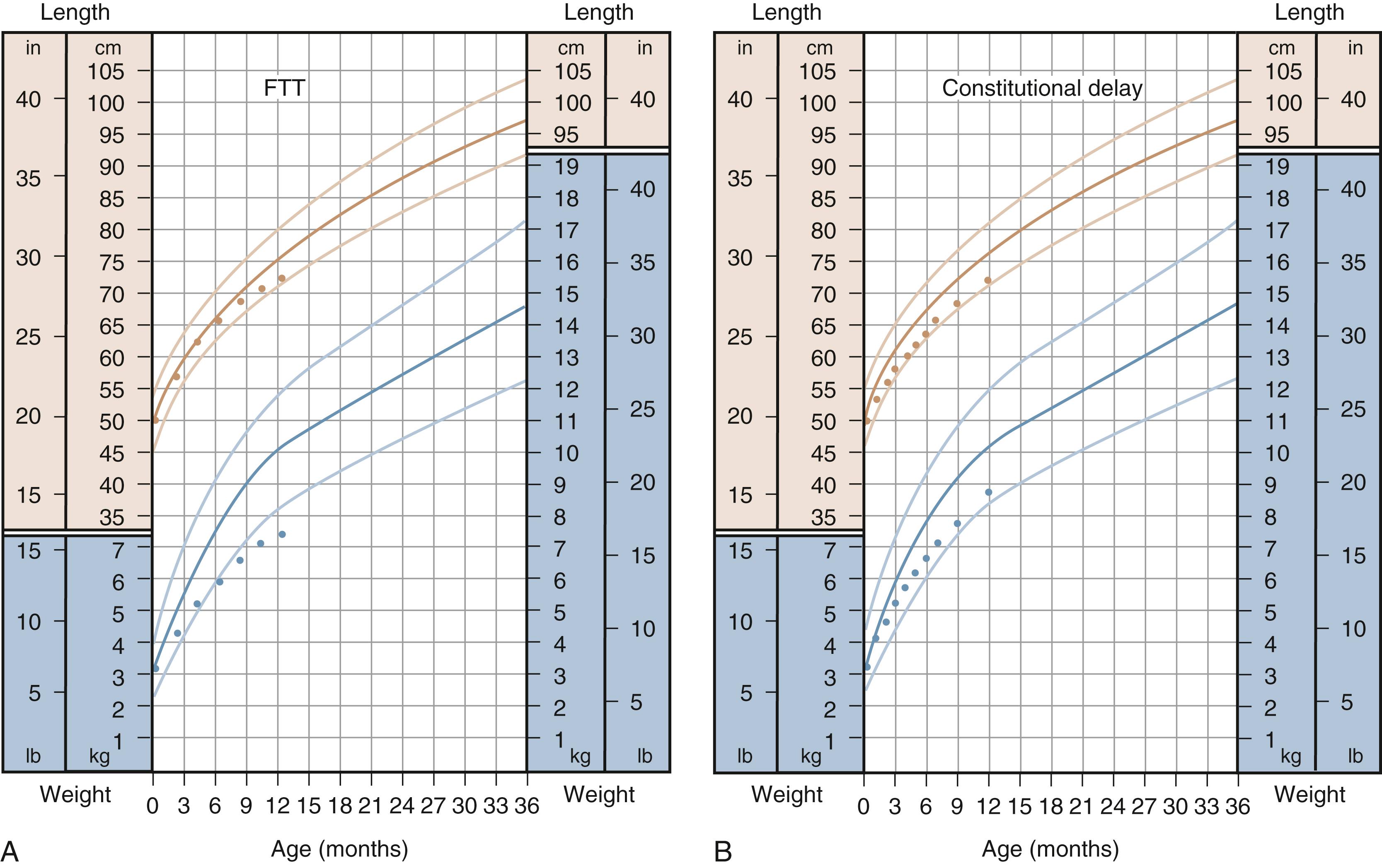 Fig. 11.8, Examples of growth curves. (A) Typical failure to thrive (FTT) with deceleration of weight gain. (B) Slow growth but at a normal rate consistent with constitutional delay.