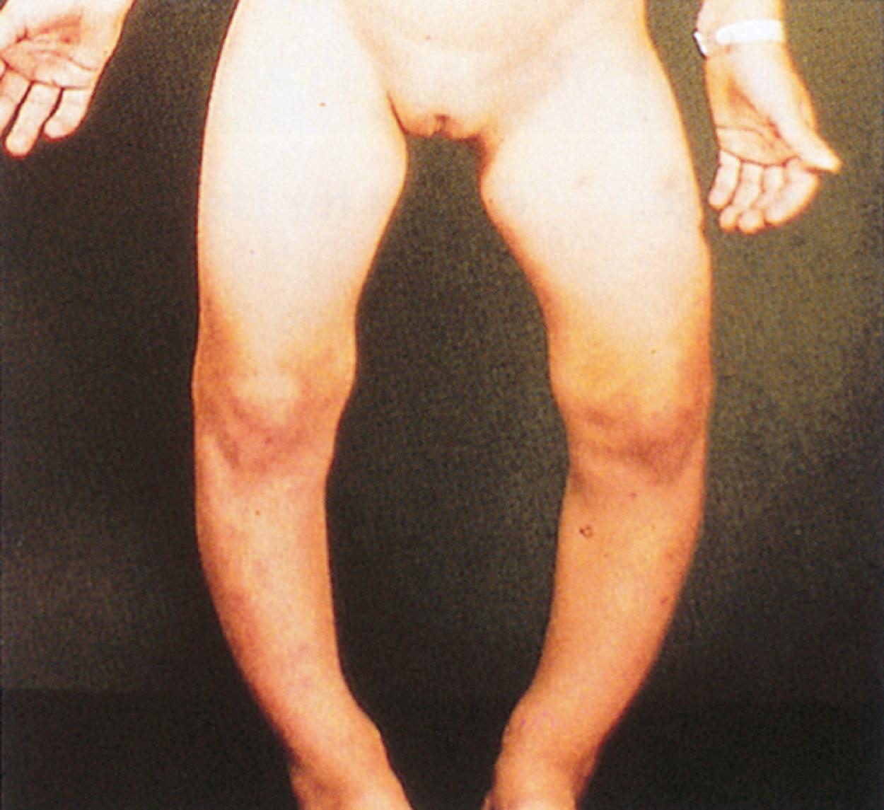 Fig. 11.9, Rickets. Hypophosphatemic rickets marked by obvious bowing of the legs.