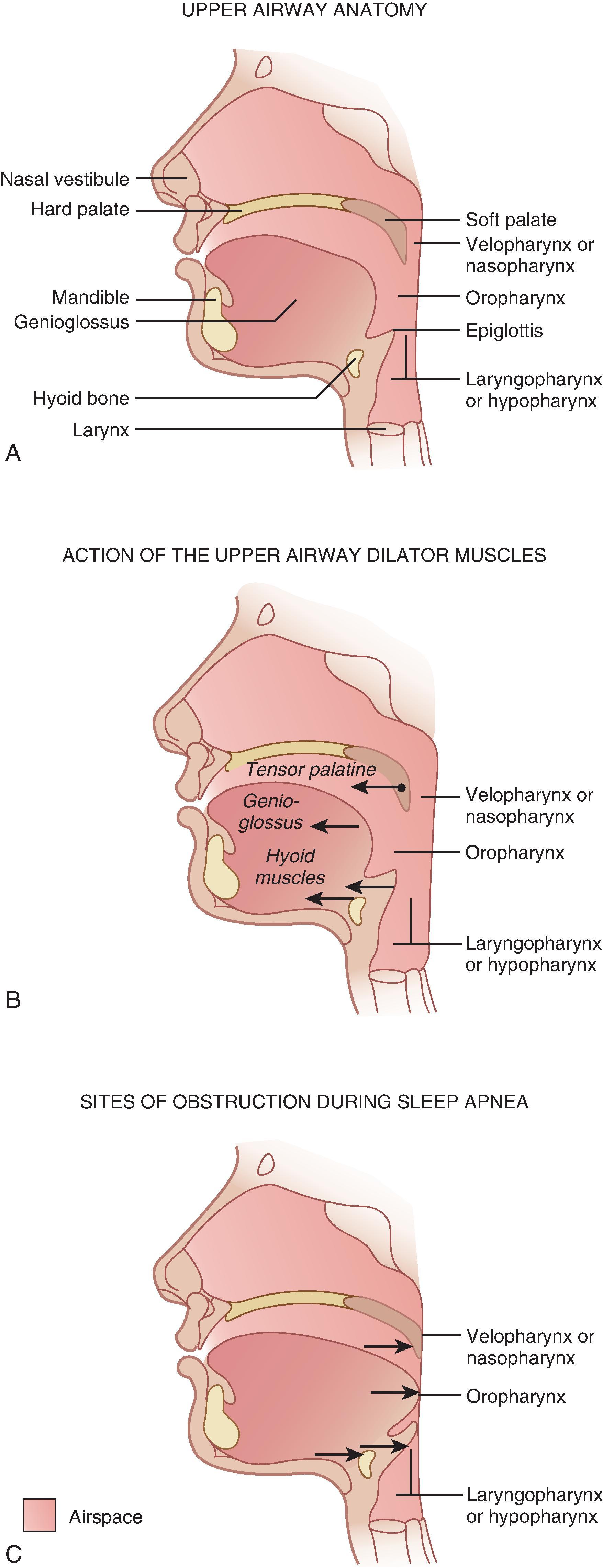 Fig. 40.1, Airway obstruction during sleep apnea. (A) The schematic drawing shows the important upper airway anatomy. The nasopharynx ends at the tip of the uvula; the oropharynx extends from the tip of the uvula to the epiglottis; and the laryngopharynx extends from the tip of the epiglottis to the posterior cricoid cartilage. (B) The drawing shows the action of the most important dilator muscles of the upper airway. The tensor palatine, genioglossus, and hyoid muscles enlarge the nasopharynx, oropharynx, and laryngopharynx, respectively. (C) The drawing shows collapse of the nasopharynx at the palatal level, the oropharynx at the glottic level, and the laryngopharynx at the epiglottic level.