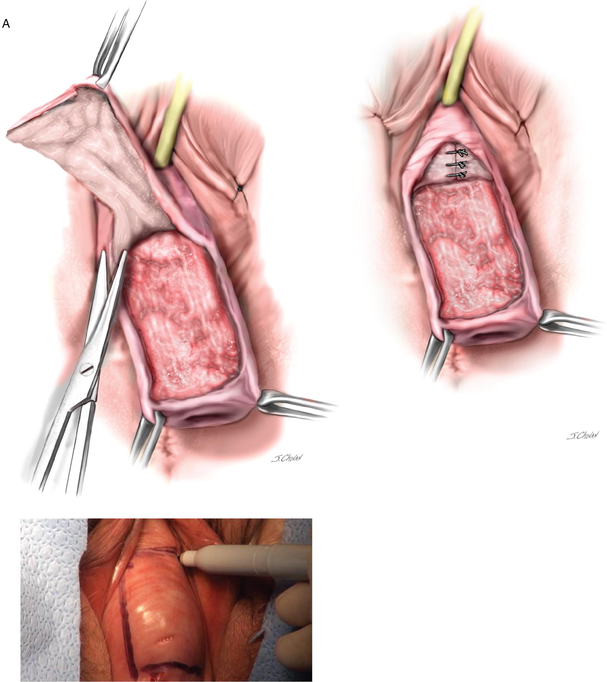 Fig. 23.1, Le Fort partial colpocleisis. A , A rectangular piece of anterior vaginal wall has been removed. Note in the inset that the dissection has been extended laterally at the level of the proximal urethra to perform a Kelly–Kennedy plication in the hope of providing preferential support to the bladder neck and thus preventing any occult or potential stress incontinence. B , A similar rectangular piece of posterior vaginal wall is removed. A portion of the posterior vaginal wall will usually lie over an enterocele, and the surgeon should attempt to avoid entering the peritoneal cavity if at all possible. C , The cut edge of the anterior incision at the level of the cervix is sewn to the distal cut edge of the posterior incision with interrupted No. 2-0 delayed absorbable sutures. ( inset ) Once the cervix is inverted, the interrupted sutures are taken through the cut edges of the lateral portions of the incision. D , Once the entire vagina has been inverted, the superior and inferior margins over the rectangle can be sutured horizontally, thus completely obliterating the midportion of the vagina. Note: draining channels are left in the lateral portions of the vagina to facilitate drainage of any cervical discharge. A levatoroplasty is commonly performed to increase posterior pelvic muscle support and narrow the introitus. (See Fig. 23.3 for technique of levatoroplasty.)