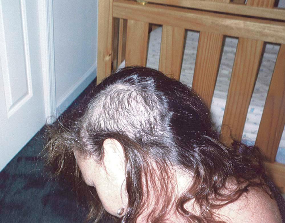 Figure 33-2, Left-side view of a trichotillomania patient's scalp demonstrating areas of alopecia (balding) and hair thinning.