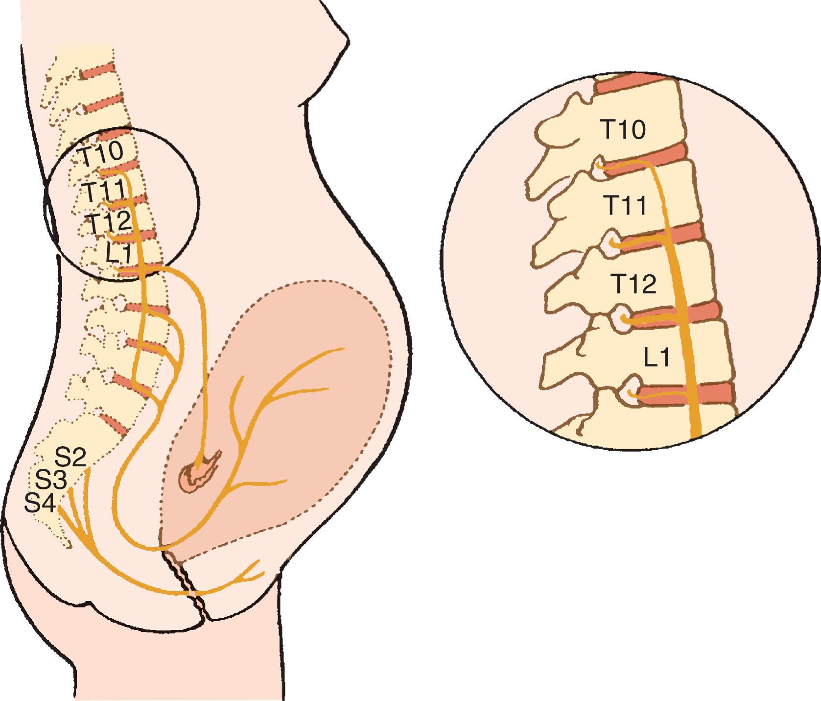 Fig. 14.1, Parturition pain pathways. Nerves that accompany sympathetic fibers and enter the neuraxis at the T10, T11, T12, and L1 spinal levels carry afferent pain impulses from the cervix and uterus. Pain pathways from the perineum travel to S2, S3, and S4 via the pudendal nerve.
