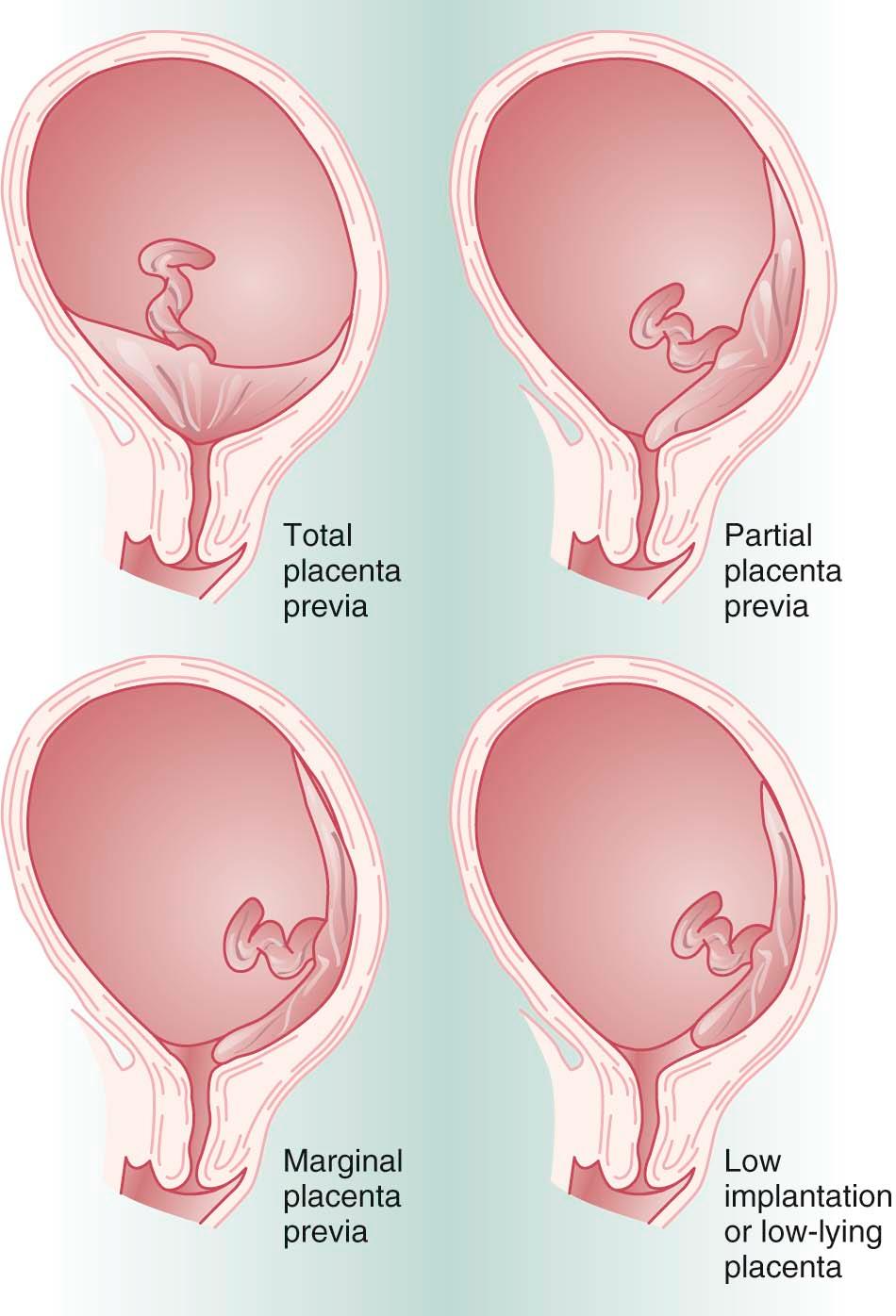 FIGURE 10-1, Types of placenta previa.